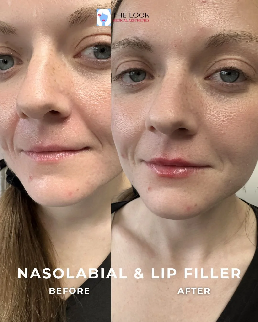 Before and after photos of facial balancing and dermal filler treatment in Carmel, IN at The Look Medical Aesthetics,  a top-rated med spa just North of Indianapolis, IN in downtown Carmel, Indiana.  