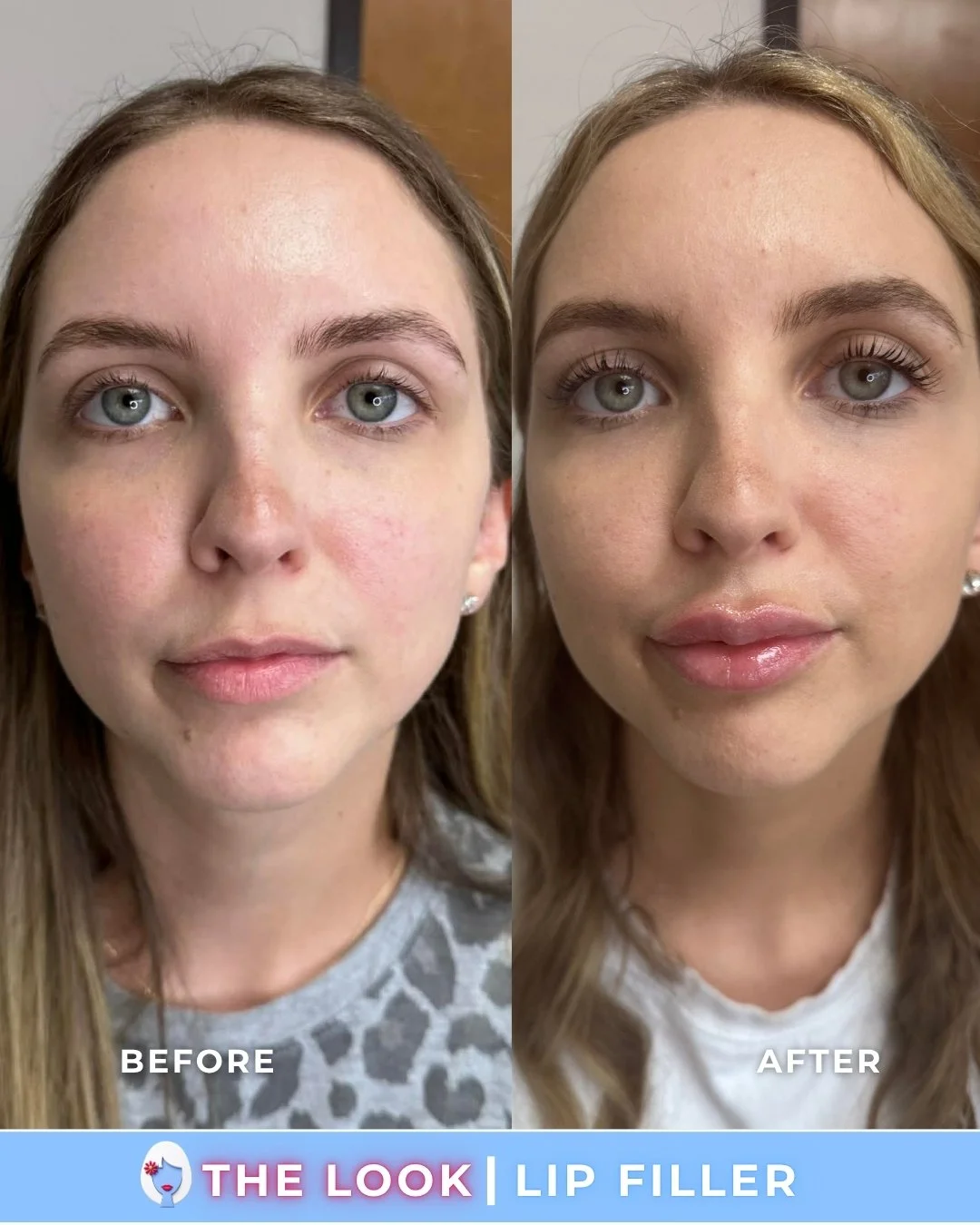 Side-by-side comparison of a woman's face showing before and after lip filler treatment. The before image shows natural lips, and the after image shows fuller, plumper lips. Text overlay: "The Look | Lip Filler."