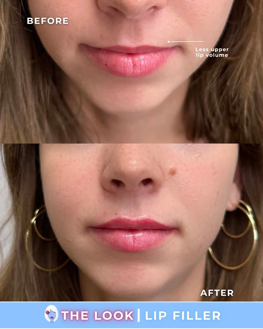 Lip filler (1/2 syringe) at The Look Medical Aesthetics in Carmel, Indiana!