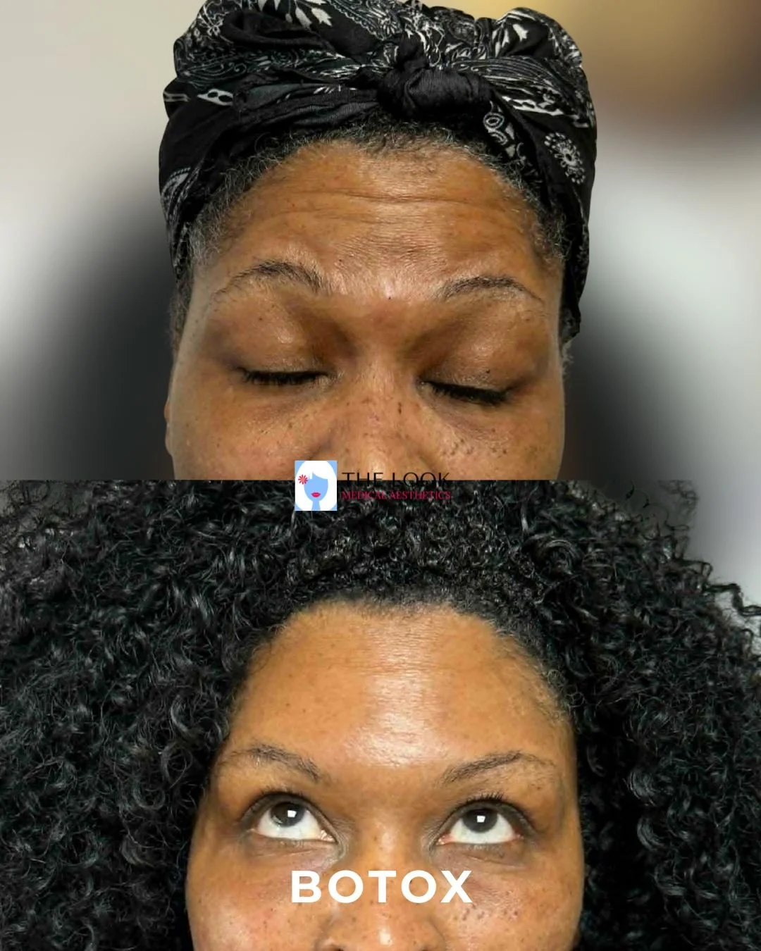 Letybo botox shows excellent results for the forehead after only 3 days for this client at The Look Medical Spa in Carmel, Indiana!