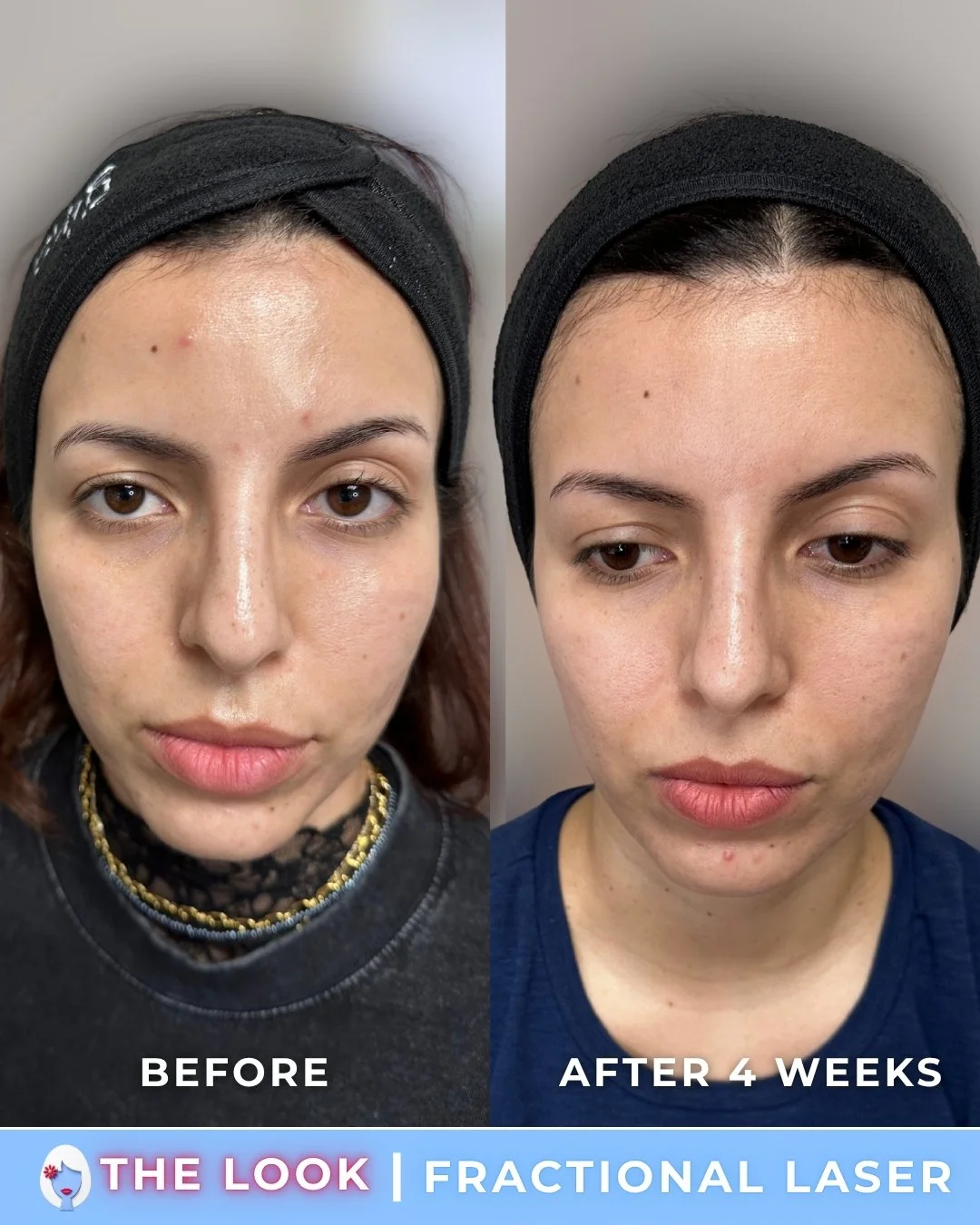 Side-by-side comparison of a woman’s face before and four weeks after fractional laser treatment showing reduction in acne scars and skin texture improvement.