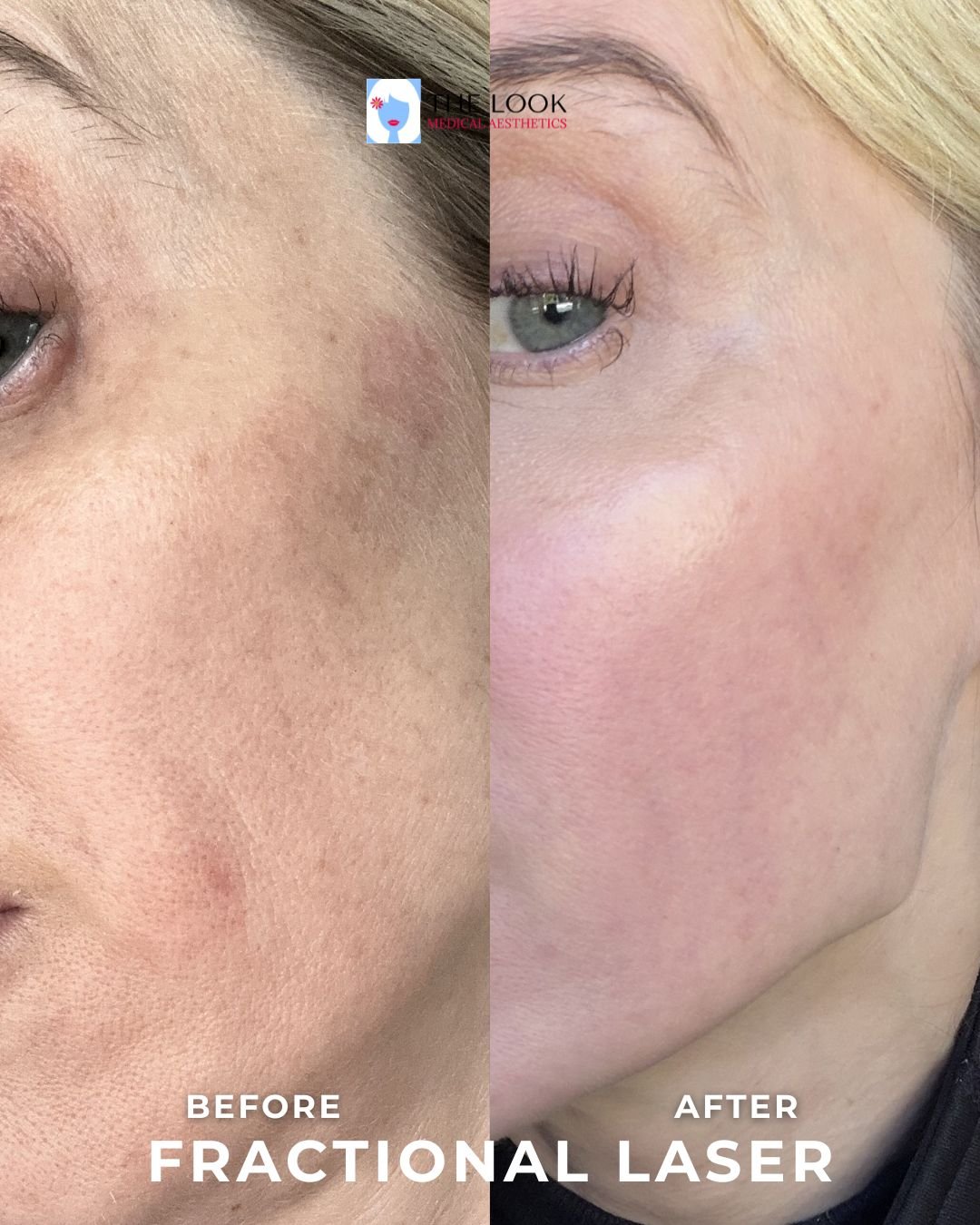 Before and after photos of CO2 laser peel treatment in Carmel, IN at The Look Medical Aesthetics,  a top-rated med spa just North of Indianapolis, IN