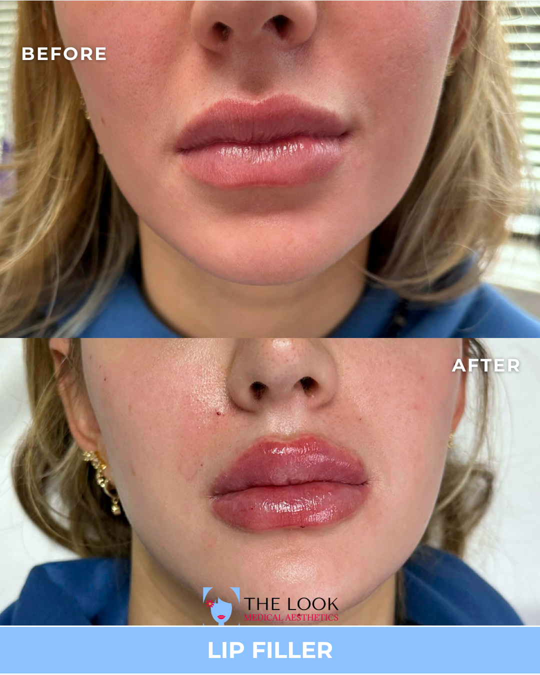 Before and after images showing the results of lip filler treatment on a woman's lips, with the 'before' image displaying natural lips and the 'after' image showing plumper, more defined lips.