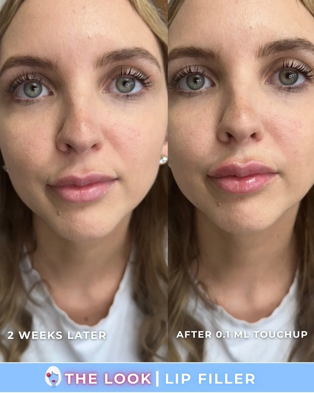 Side-by-side comparison of a woman's face showing the results of lip filler treatment, with the left side labeled '2 weeks later' and the right side labeled 'after 0.1 mL touchup,' highlighting fuller lips after the procedure.