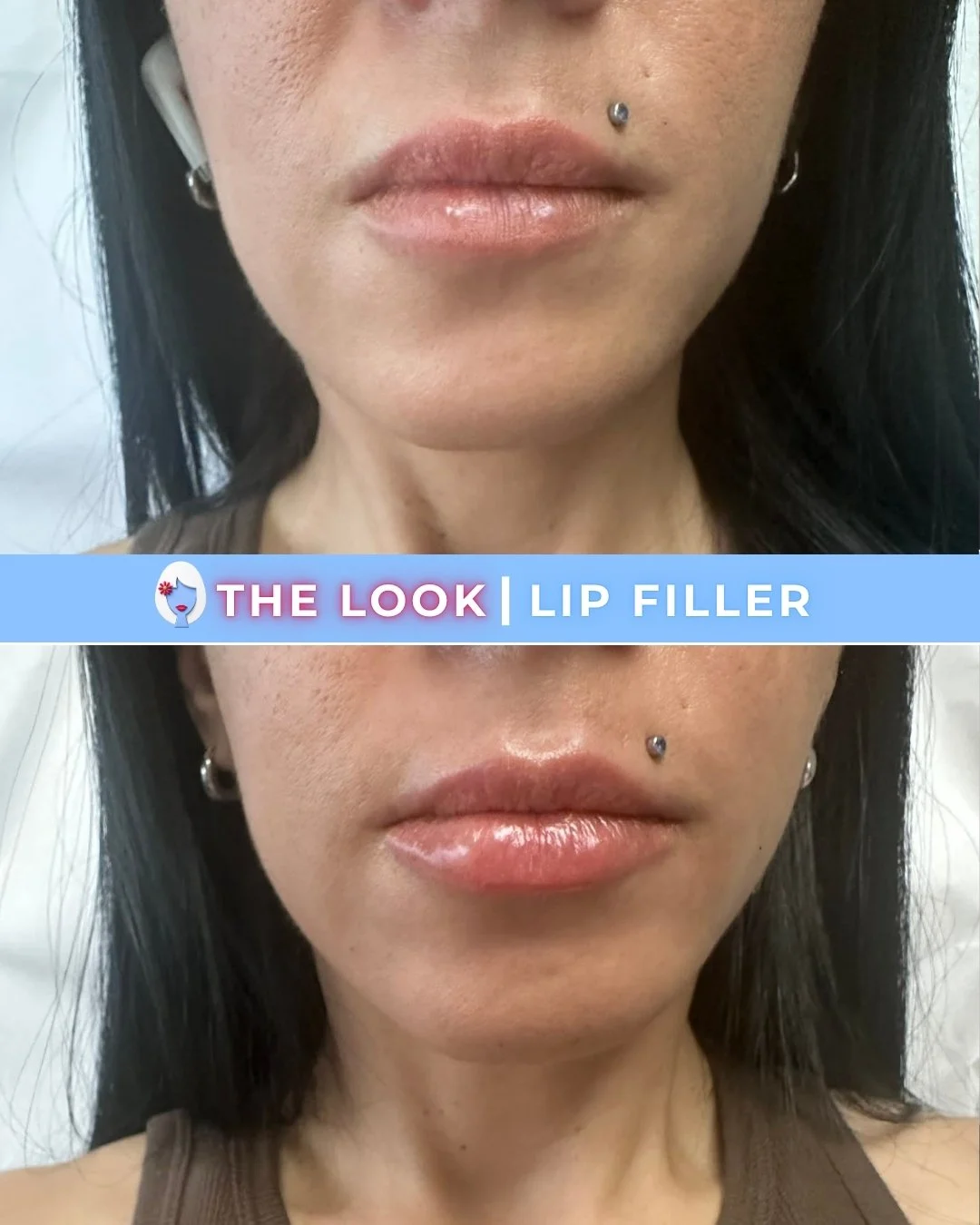 Before-and-after comparison of lips showing the effects of lip filler. The top image shows lips before treatment, and the bottom image shows fuller, more defined lips after lip filler. The woman has a small labret piercing above her upper lip and wea