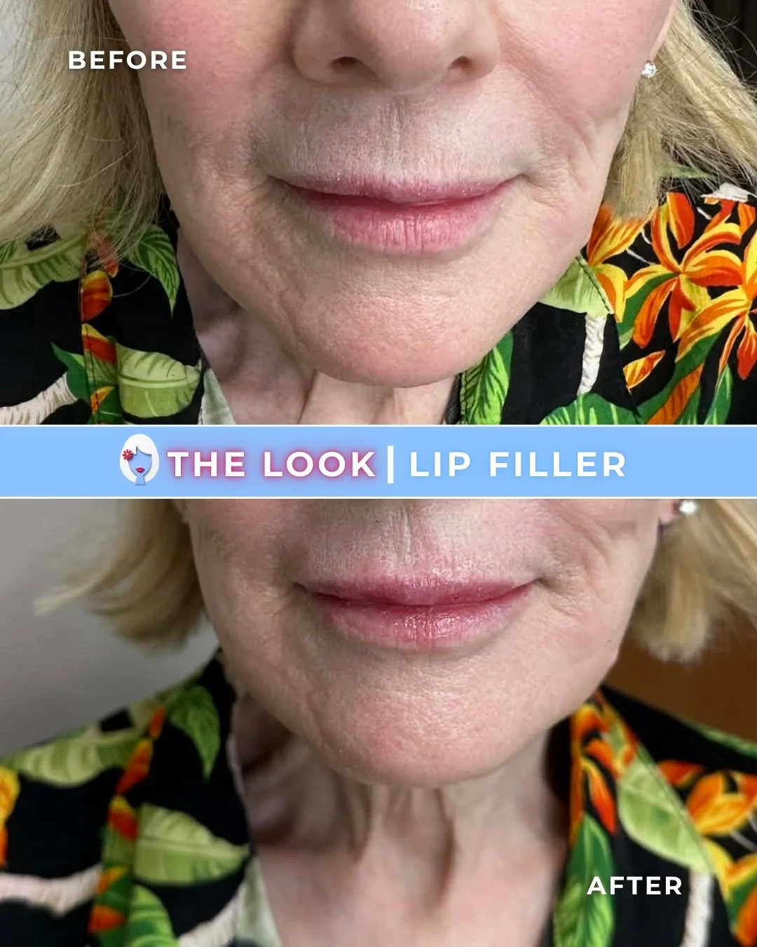 Close-up of a woman's lips before and after lip filler treatment, showing smoother and fuller lips in the after photo.