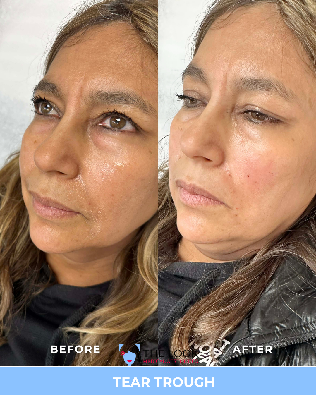 Side-by-side comparison of a woman before and after tear trough treatment, showing reduced under-eye hollows and smoother skin.