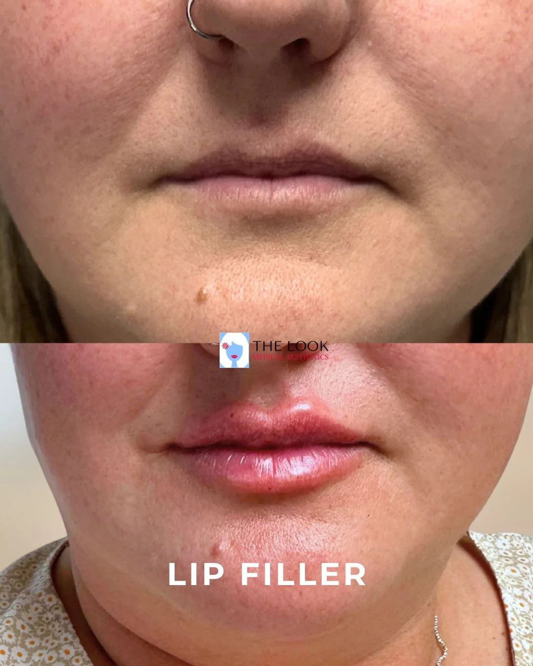 First time lip filler client at The Look Medical Spa in Carmel, IN; she was so happy with her results!