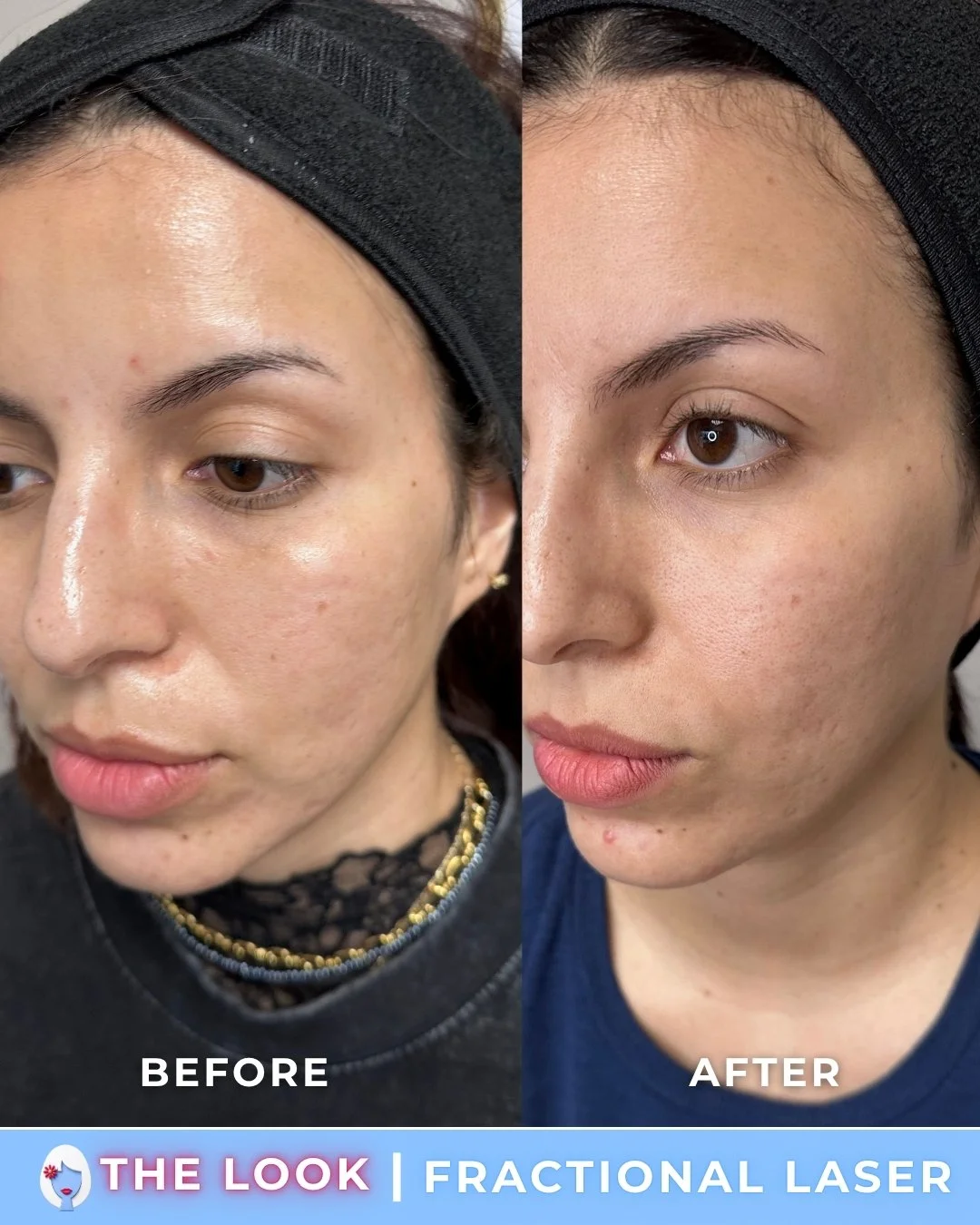Side-by-side comparison of a woman's face before and after a fractional laser skin treatment, showing improved skin texture and clarity.
