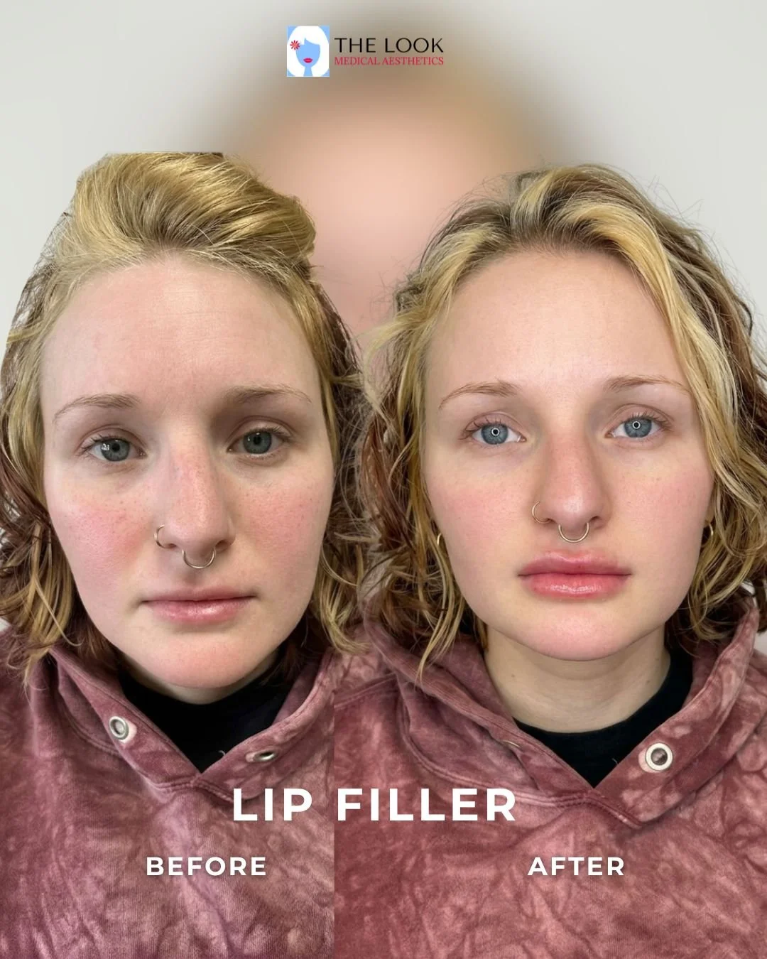 Before and after photos of Lip filler in Carmel, IN at The Look Medical Aesthetics,  a top-rated med spa just North of Indianapolis, IN