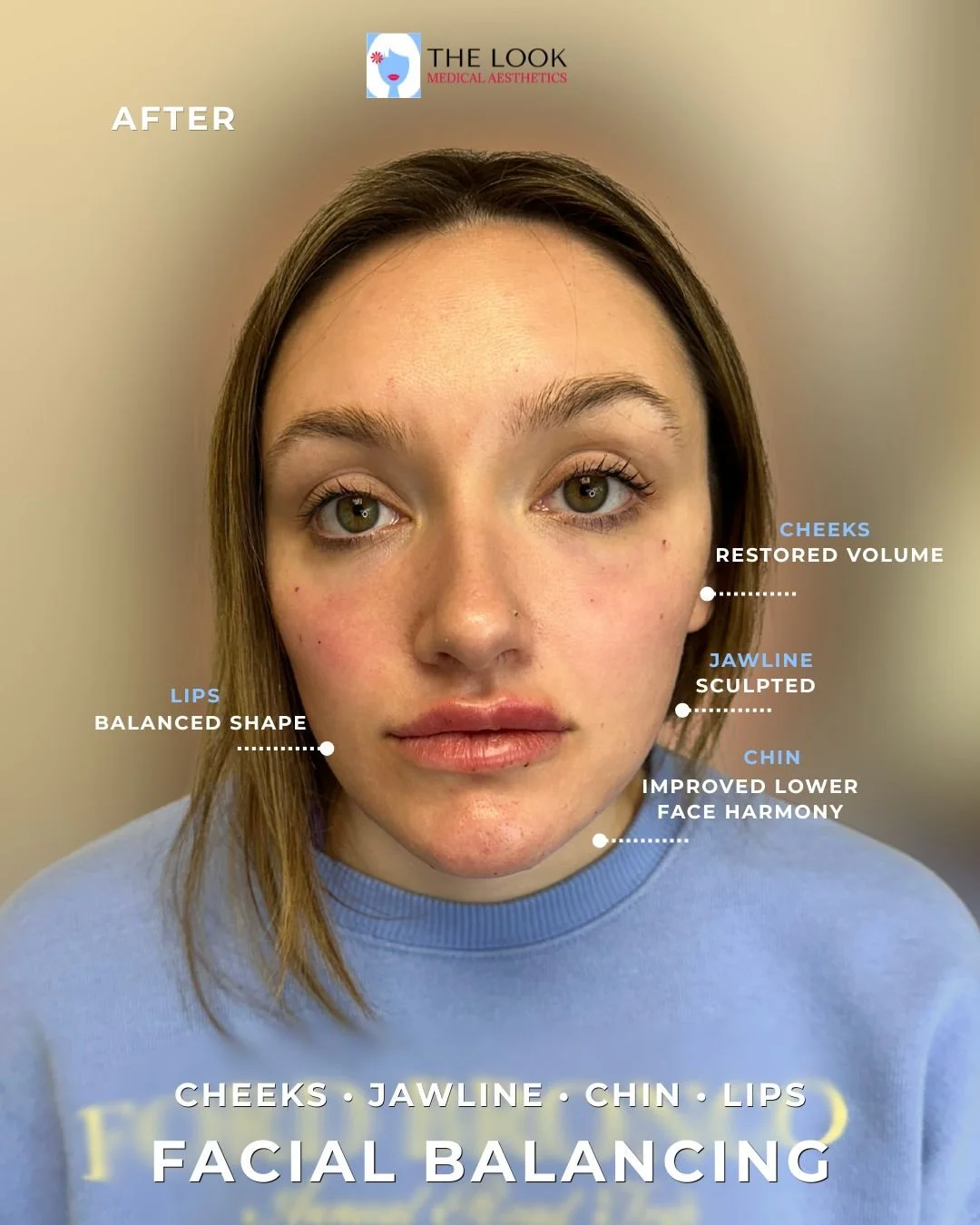 Before and after photos of facial balancing and dermal filler treatment in Carmel, IN at The Look Medical Aesthetics,  a top-rated med spa just North of Indianapolis, IN in downtown Carmel, Indiana.  