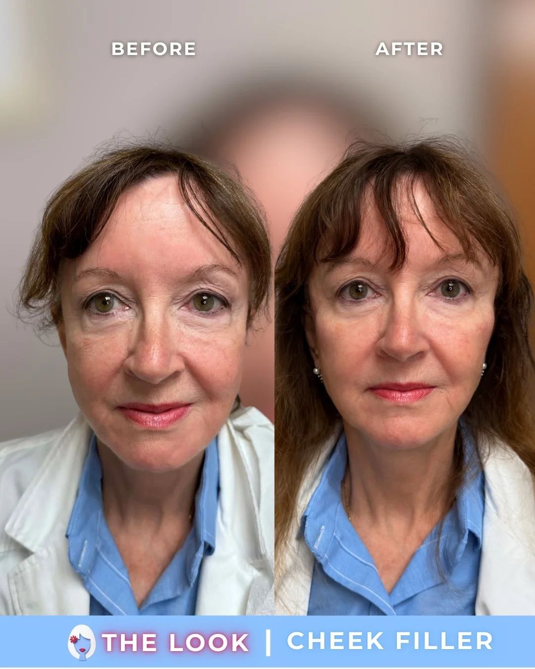 the look medical aesthetics filler before and afters (1).jpg
