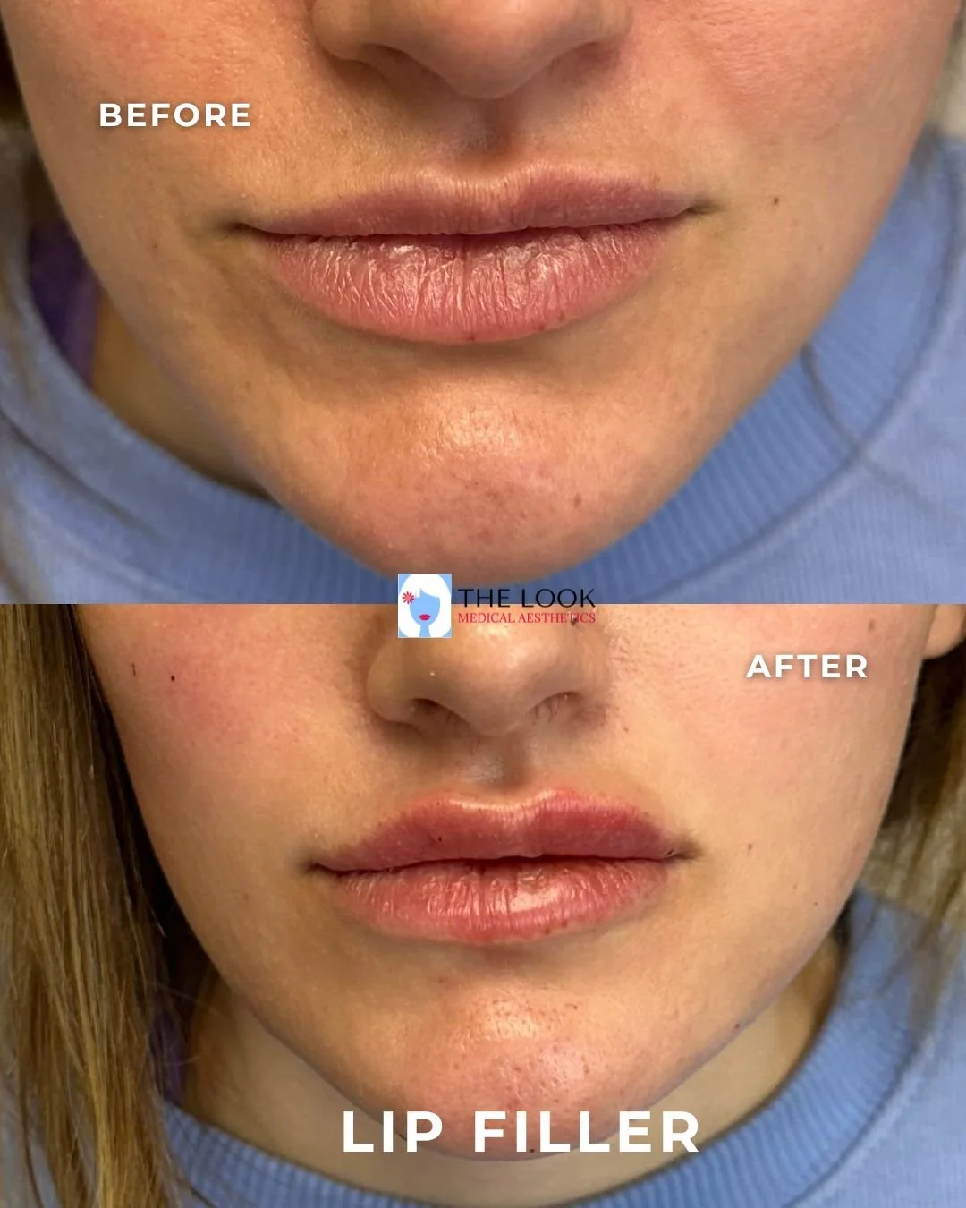 Lip filler before and after at The Look Medical Aesthetics, a Med Spa in Carmel, IN.  