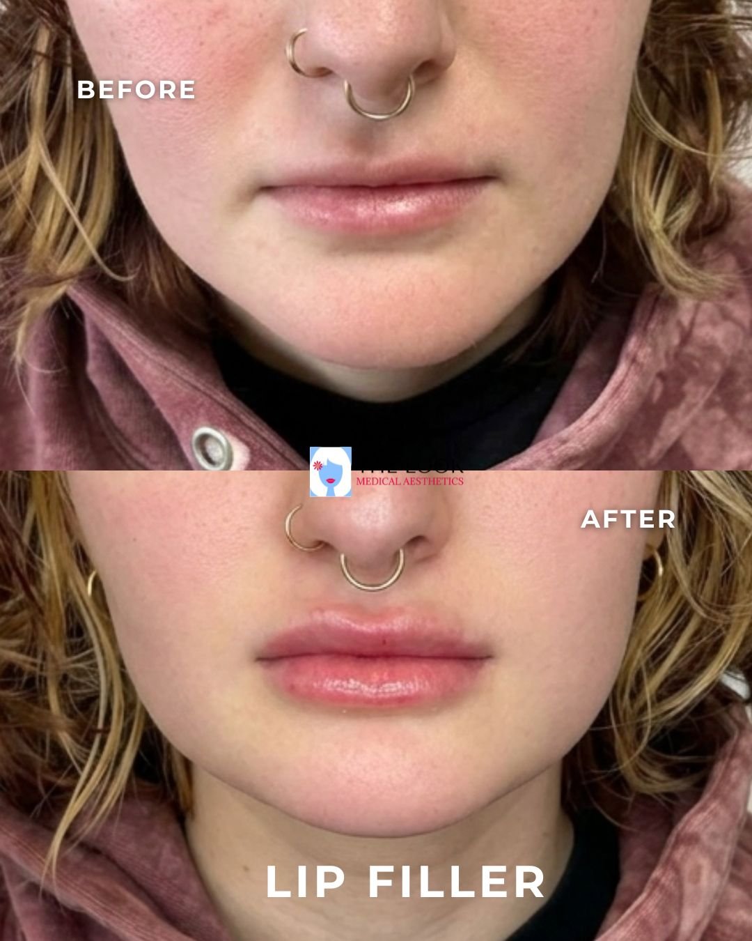 Before and after photos of lip filler treatment in Carmel, IN at The Look Medical Aesthetics,  a top-rated med spa just North of Indianapolis, IN in downtown Carmel, Indiana.  