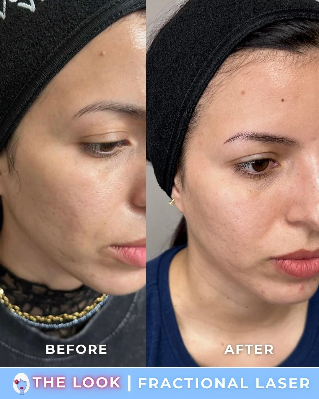 Side-by-side comparison of a woman's face before and after fractional laser skin treatment, showing reduced skin imperfections.
