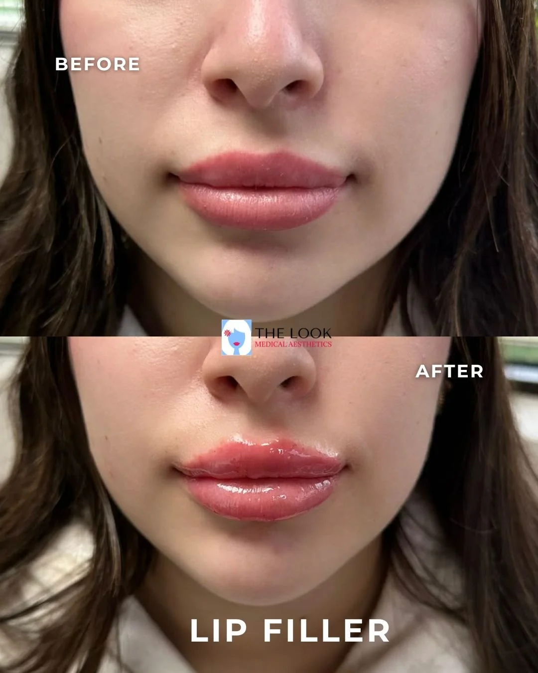 Before and after photos of lip filler treatment in Carmel, IN at The Look Medical Aesthetics,  a top-rated med spa just North of Indianapolis, IN in downtown Carmel, Indiana.  