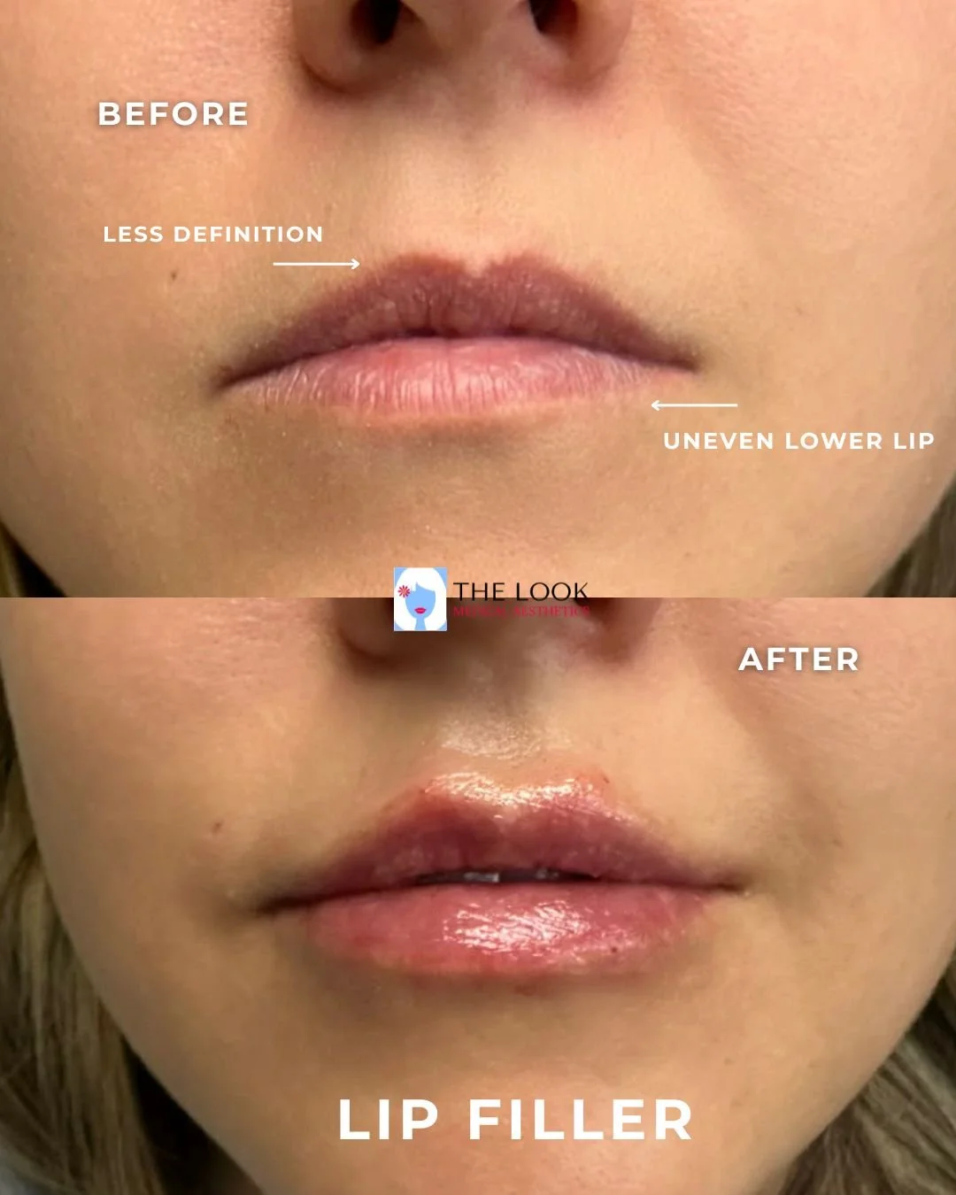 Before and after photos of Lip filler in Carmel, IN at The Look Medical Aesthetics,  a top-rated med spa just North of Indianapolis, IN