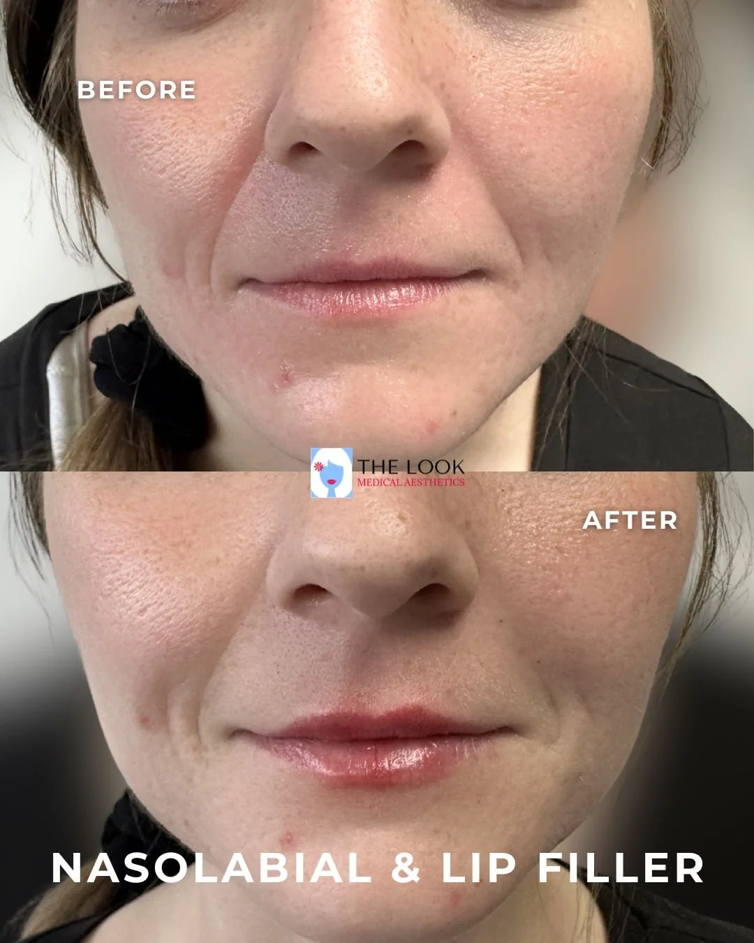 Before and after photos of Lip filler and laugh line (nasolabial) dermal filler treatment in Carmel, IN at The Look Medical Aesthetics,  a top-rated med spa just North of Indianapolis, IN in downtown Carmel, Indiana.  