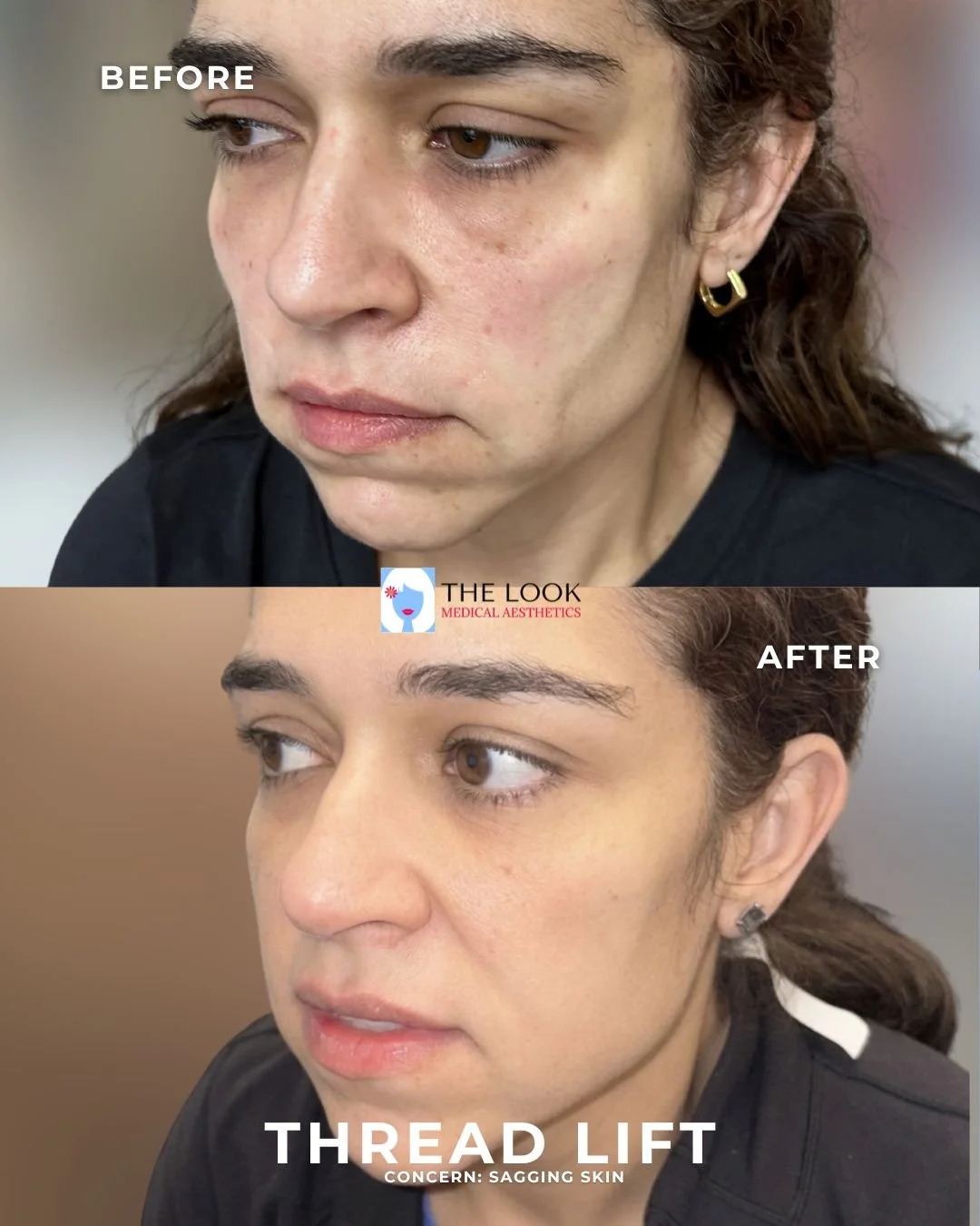 Thread lift before and after photos at The Look Medical Aesthetics, a med spa near Indianapolis, IN.