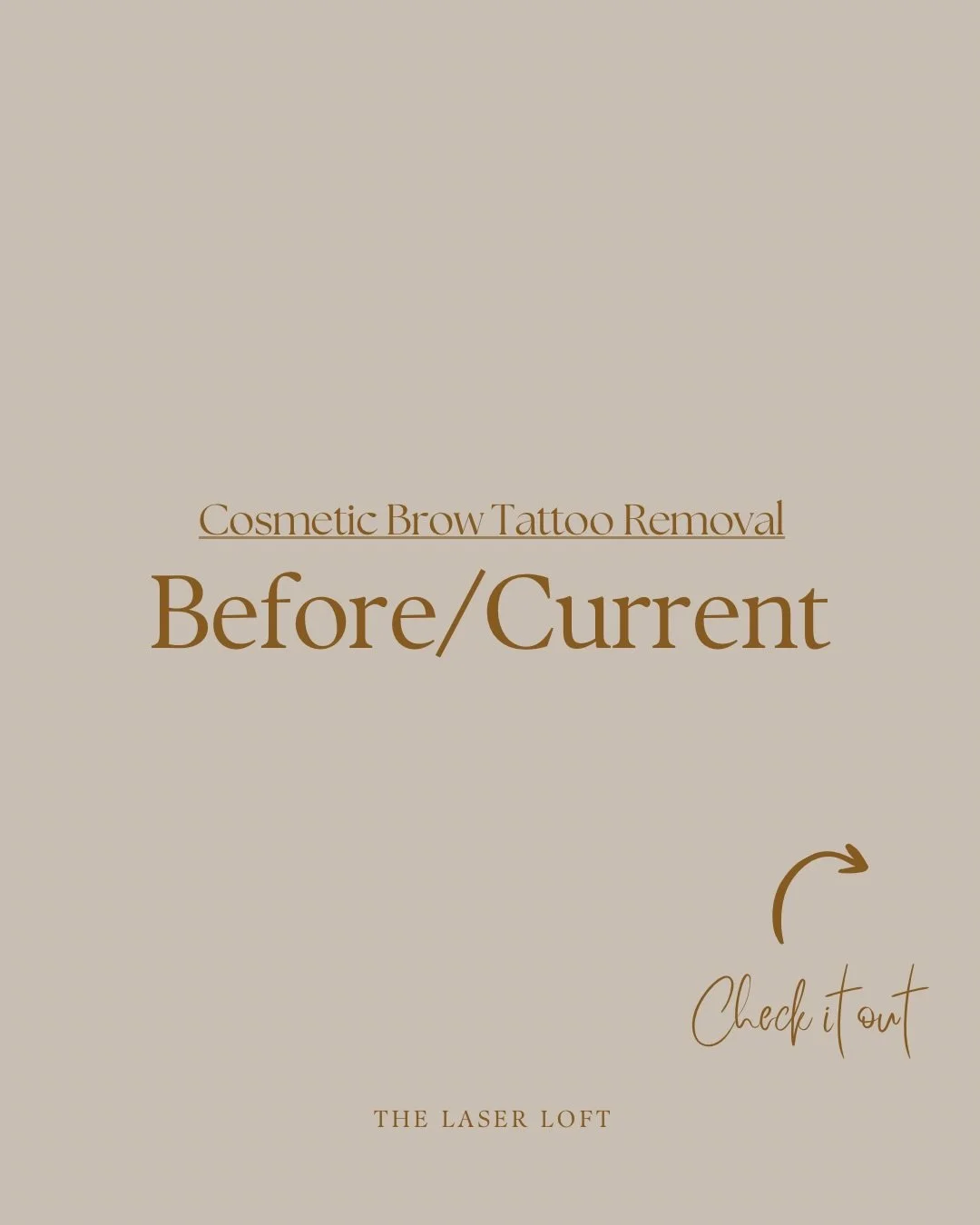 Check out this amazing Before + Current cosmetic brow tattoo removal. This stunning client is getting her brows removed to get them redone. Keep an eye out for her Before + After soon!

#browtattooremoval #tattooremoval #cosmetictattoo #laser #lasert
