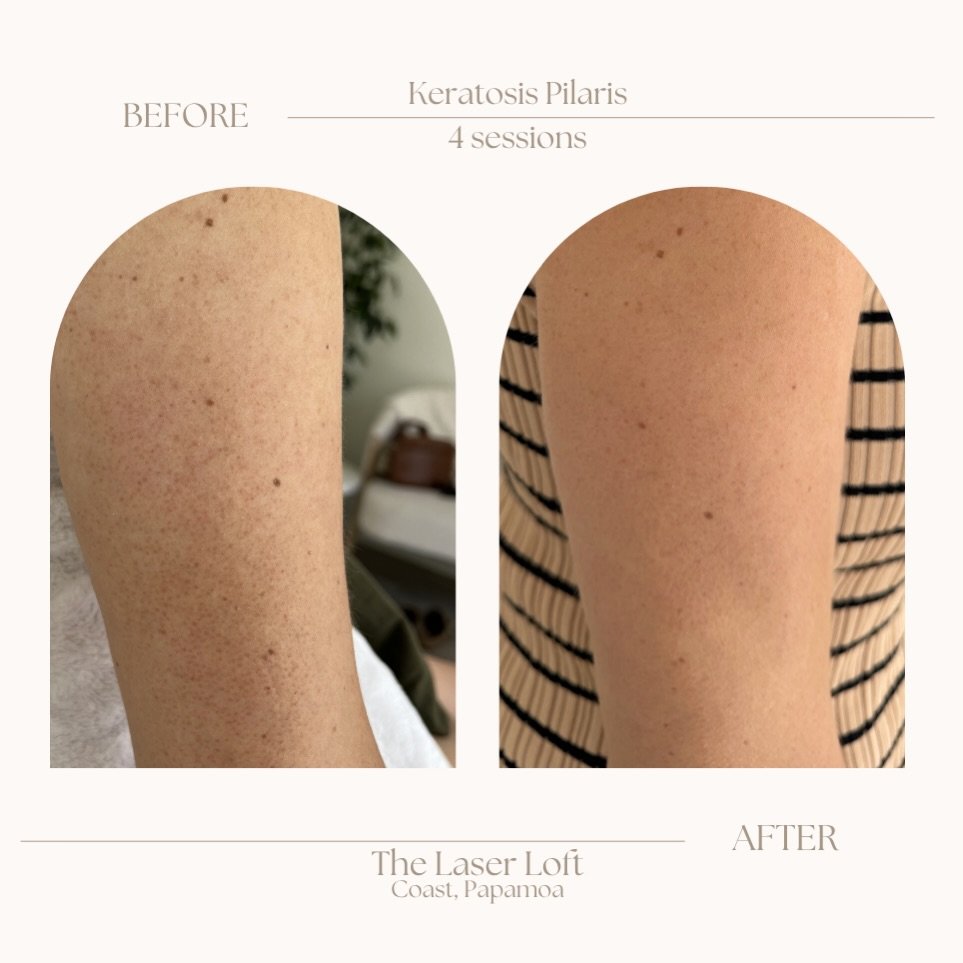 ✨ Keratosis Pilaris reduction ✨ 

Ever wondered what the bumpy red spots on the backs of your arms are? They&rsquo;re called keratosis Pilaris&hellip; it&rsquo;s a build up of keratin under the skin. 

Flick me a message to say hello to silky smooth 