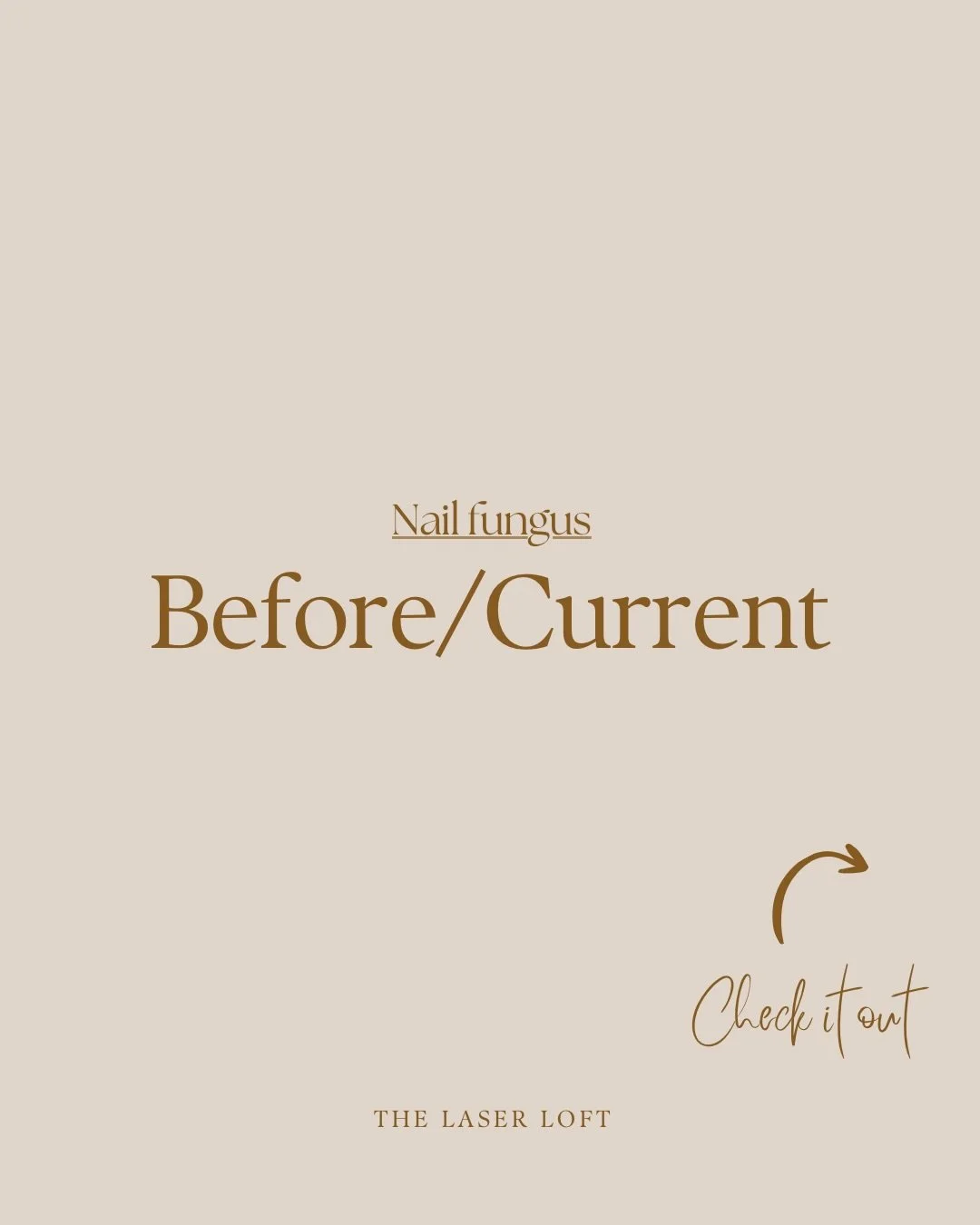 Check out this &lsquo;Before + Current&rsquo; after just one nail fungus treatment. Spot the little cuticle growing back! Keep an eye out for results after the most recent session. 

You won&rsquo;t have to live with nail fungus!! Get in touch to boo