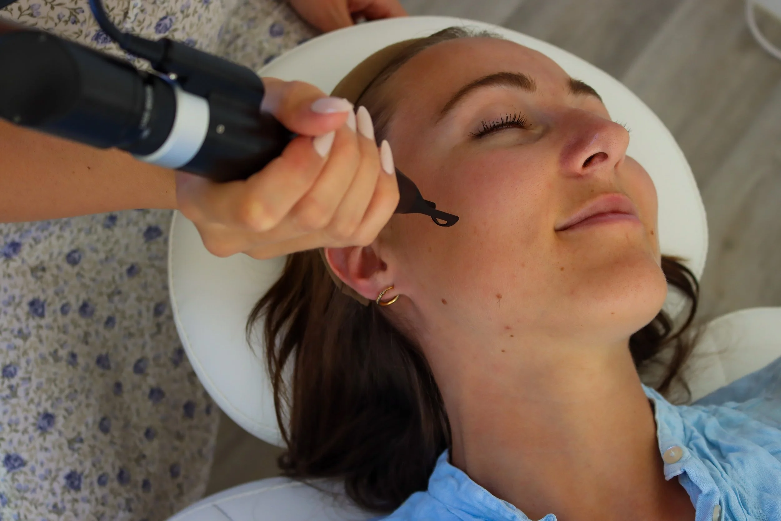 Cosmetic brow laser tattoo removal