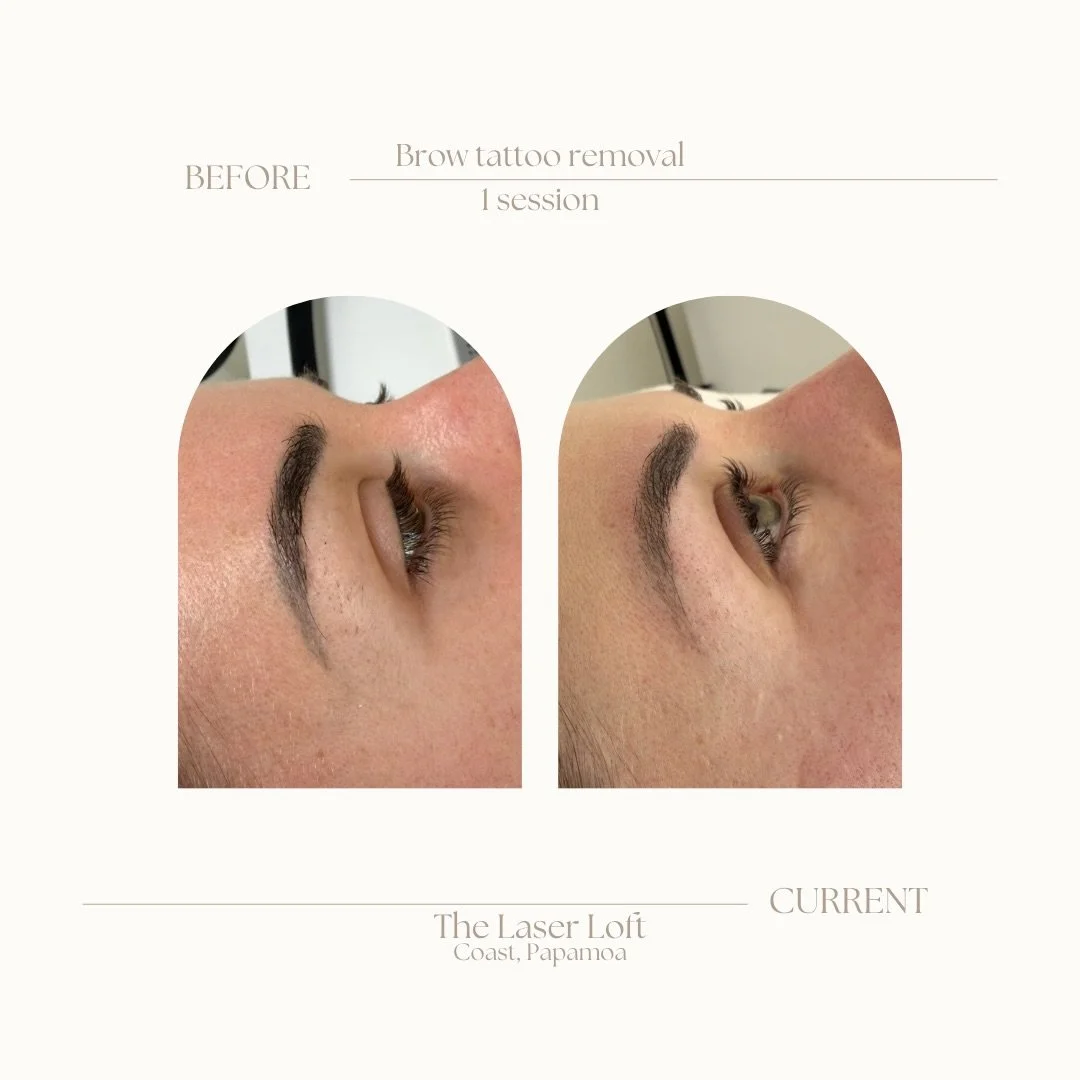 Another amazing before + current brow tattoo removal. This stunning client is after a fresh look. This is immediately after 1 session of brow tattoo removal. DM to book yours in. 

#browtattooremoval #tattooremoval #laser