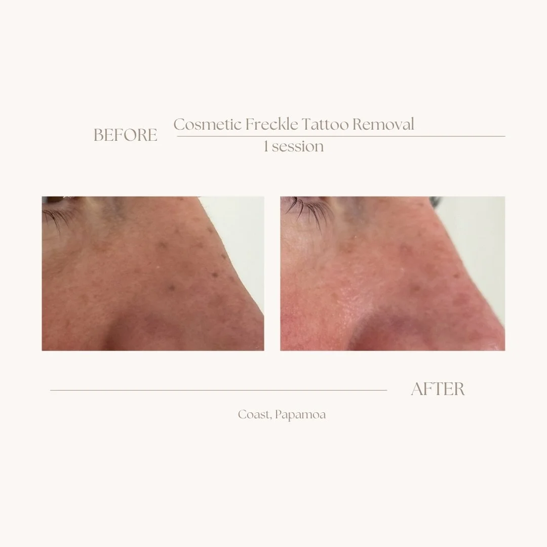 An awesome before and after for cosmetic freckle tattoo removal after just 1 session! DM to book in your tattoo removal.

#tattooremoval #cosmetictattooremoval #laser