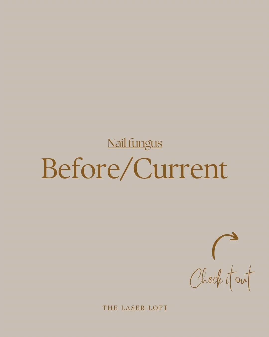 Check out the base of this nail, the nail fungus is growing out! Nail fungus is a treatment which requires patience as the nail has to fully grow out. 

DM me to get your fresh nails 💅🏾 

#laser #nailfungus #skin