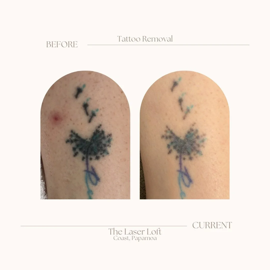 This lovely client is getting the black ink removed from her tattoo, this is after 3 sessions. With her tattoo being on her ankle it can take longer than a tattoo located on the torso to remove due to it being so far away from our major lymphatic sys