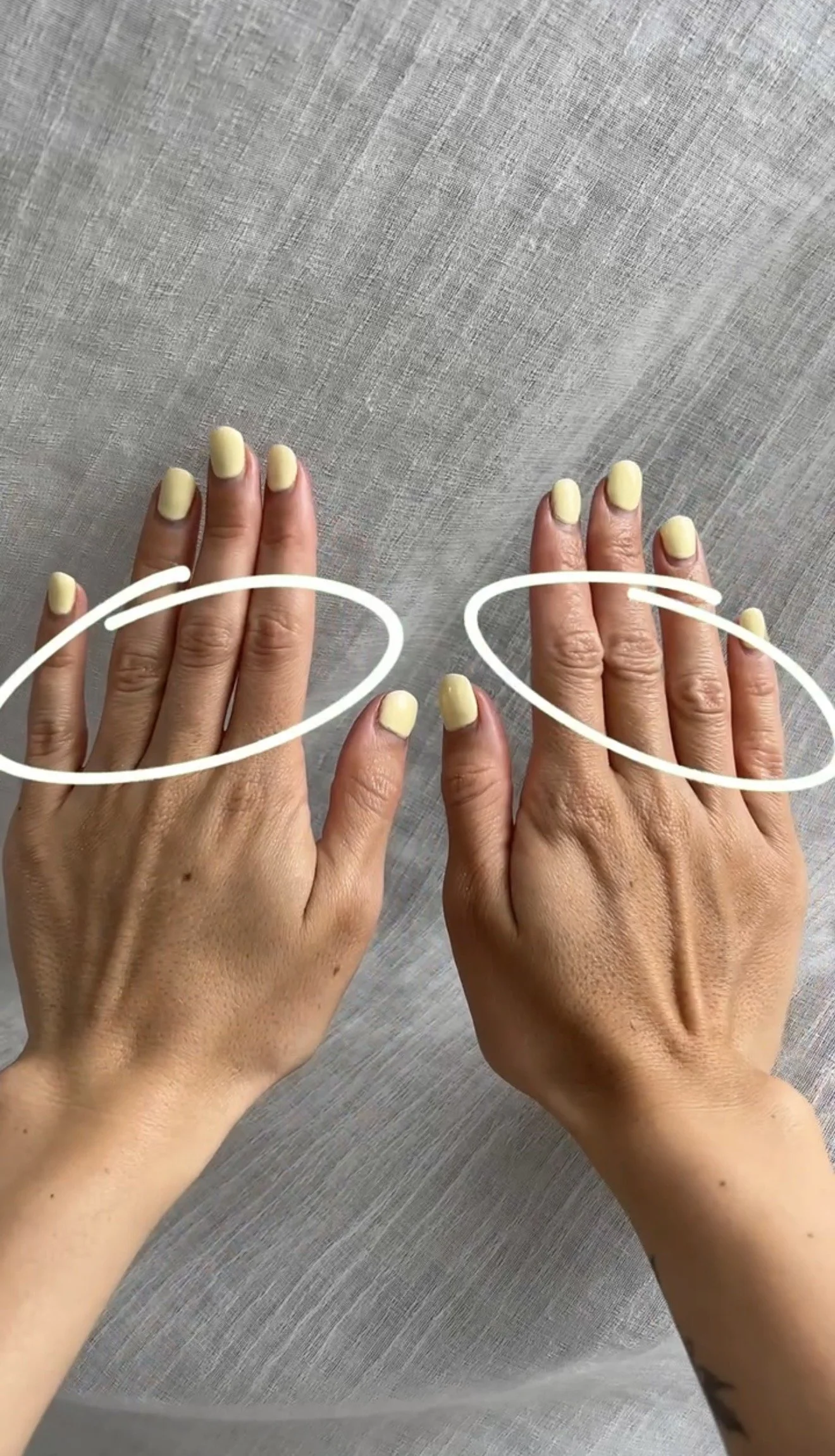 I Treated One Hand with Laser Genesis and Left the Other Untreated. Here's What Happened…