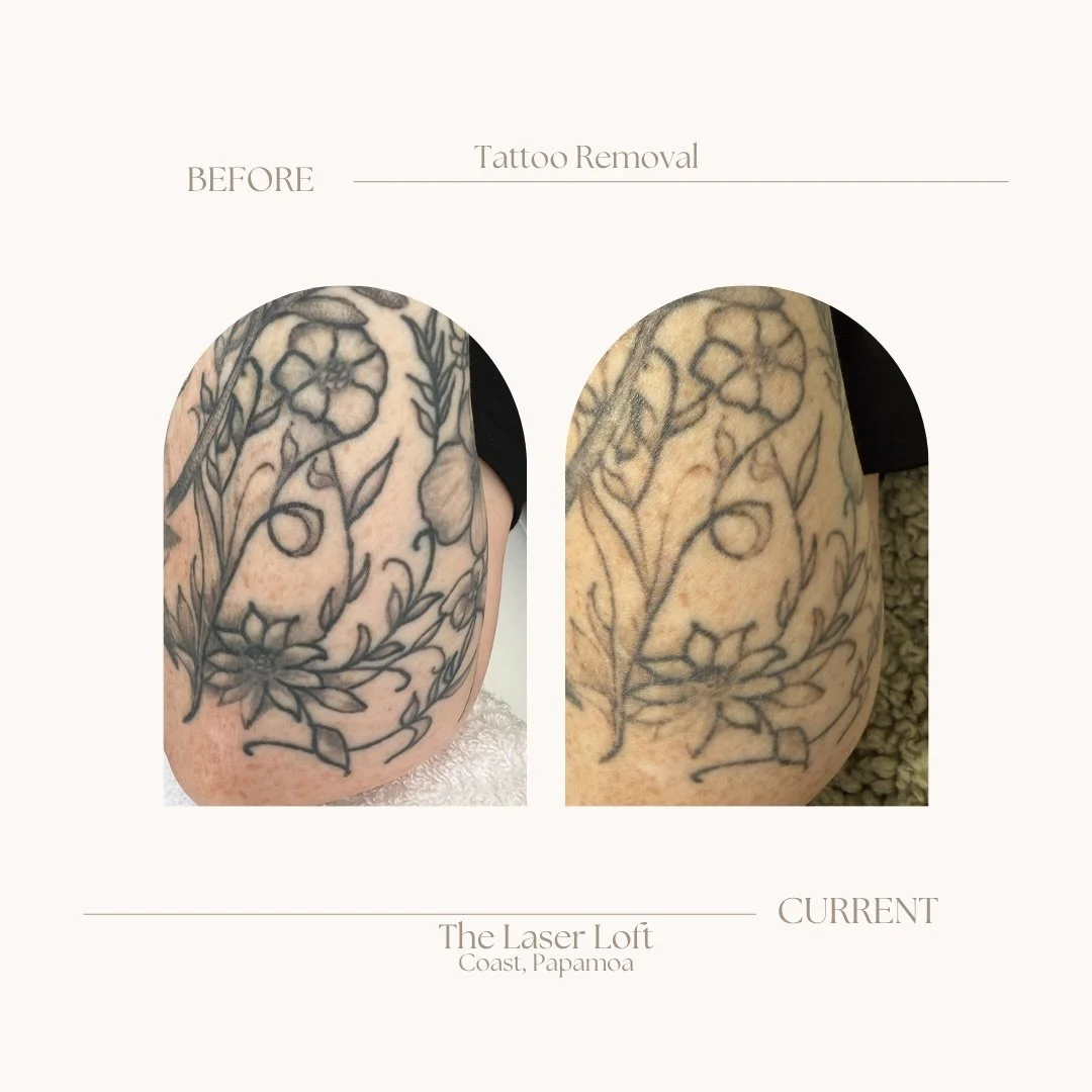 Check out this before and current. This gorgeous client is after a fading of her tattoo so she can get a cover up. By getting laser tattoo removal to lighten it, removing the dark dense lines it gives her more freedom to get the new tattoo she wants,