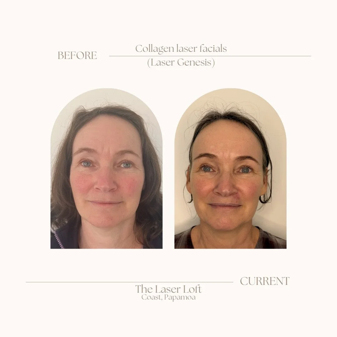 Such amazing results for this stunning client. Check out the softening of fine lines as well as a bright and healthy complexion! This gorgeous client has been having about 4 collagen treatments a year for the past 1.5 years. Can&rsquo;t wait to see t