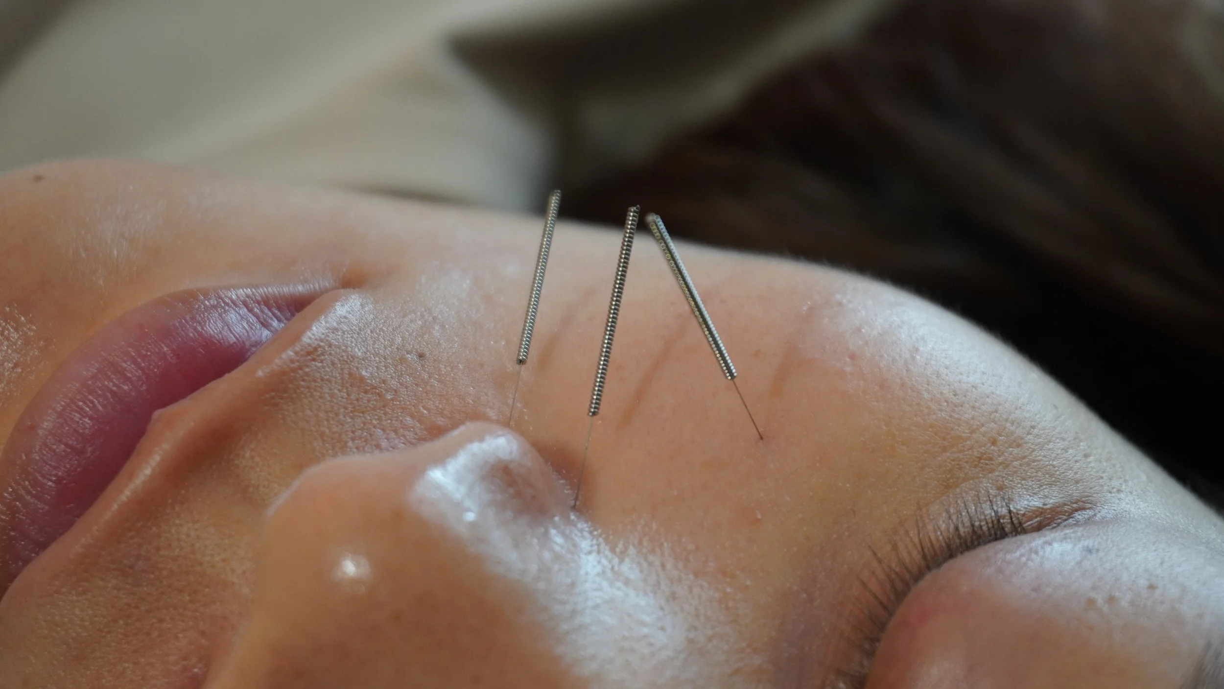 Close-up of a person's face during facial acupuncture, with three acupuncture needles inserted into the forehead and face.