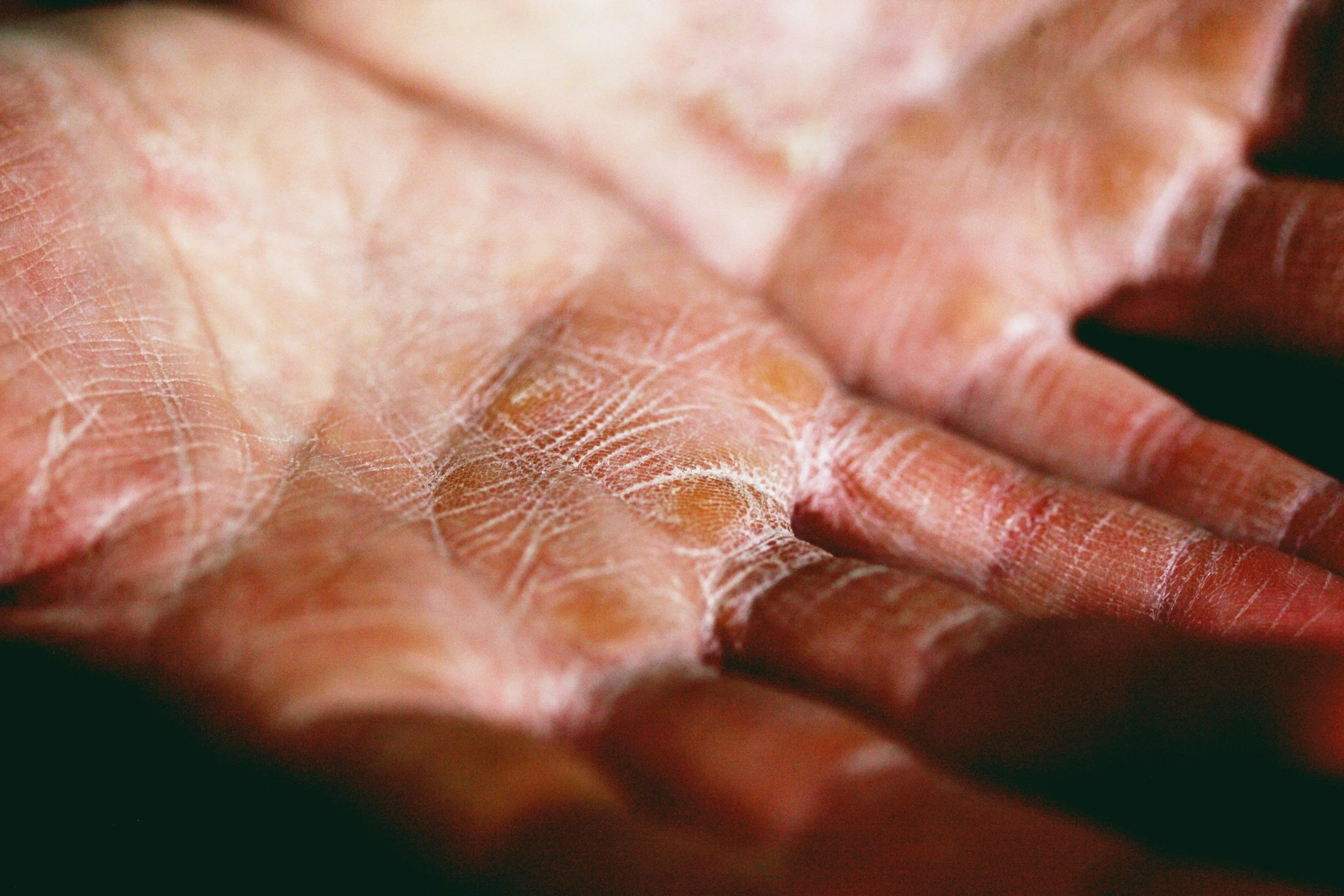 Close-up of a person's hand showing dry, peeling skin with visible cracks and lines.