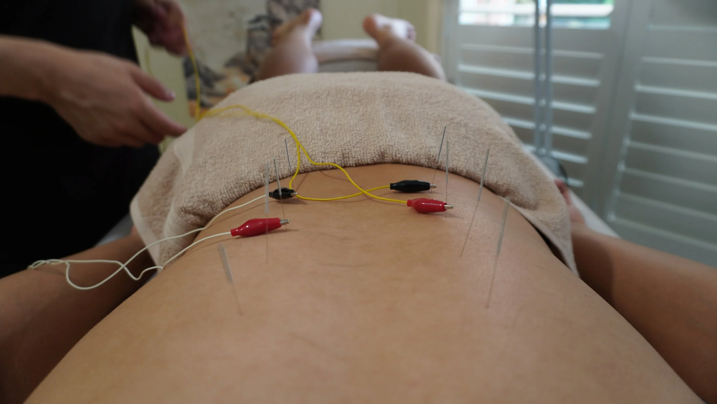 A person lying on their back receiving acupuncture treatment with multiple needles inserted into their abdomen. Electrodes and wires are attached to some of the needles, connected to a device for electrical stimulation.