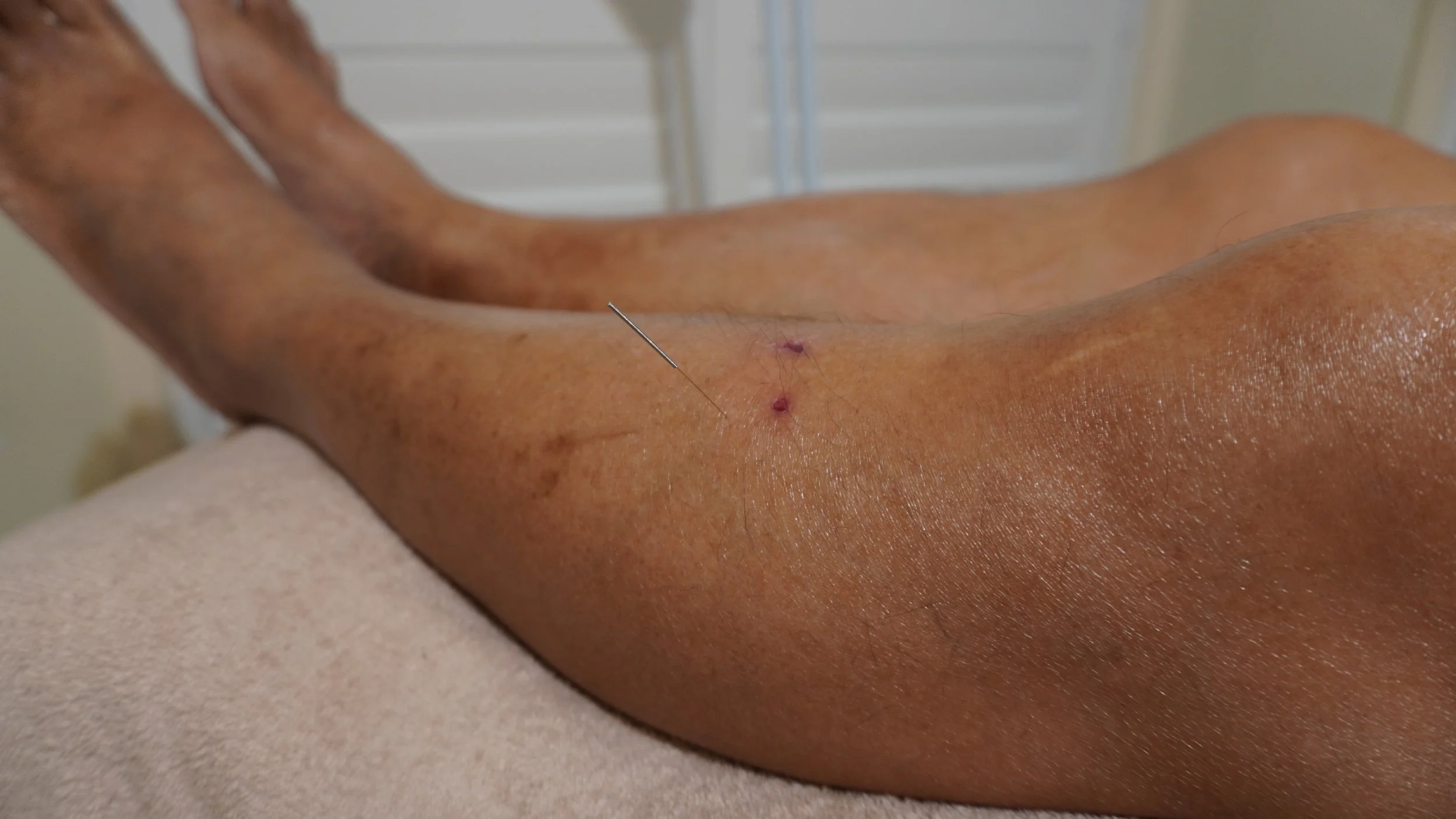 Close-up of a person's arm with a long needle inserted and bruised skin, indicating a medical or therapeutic procedure.