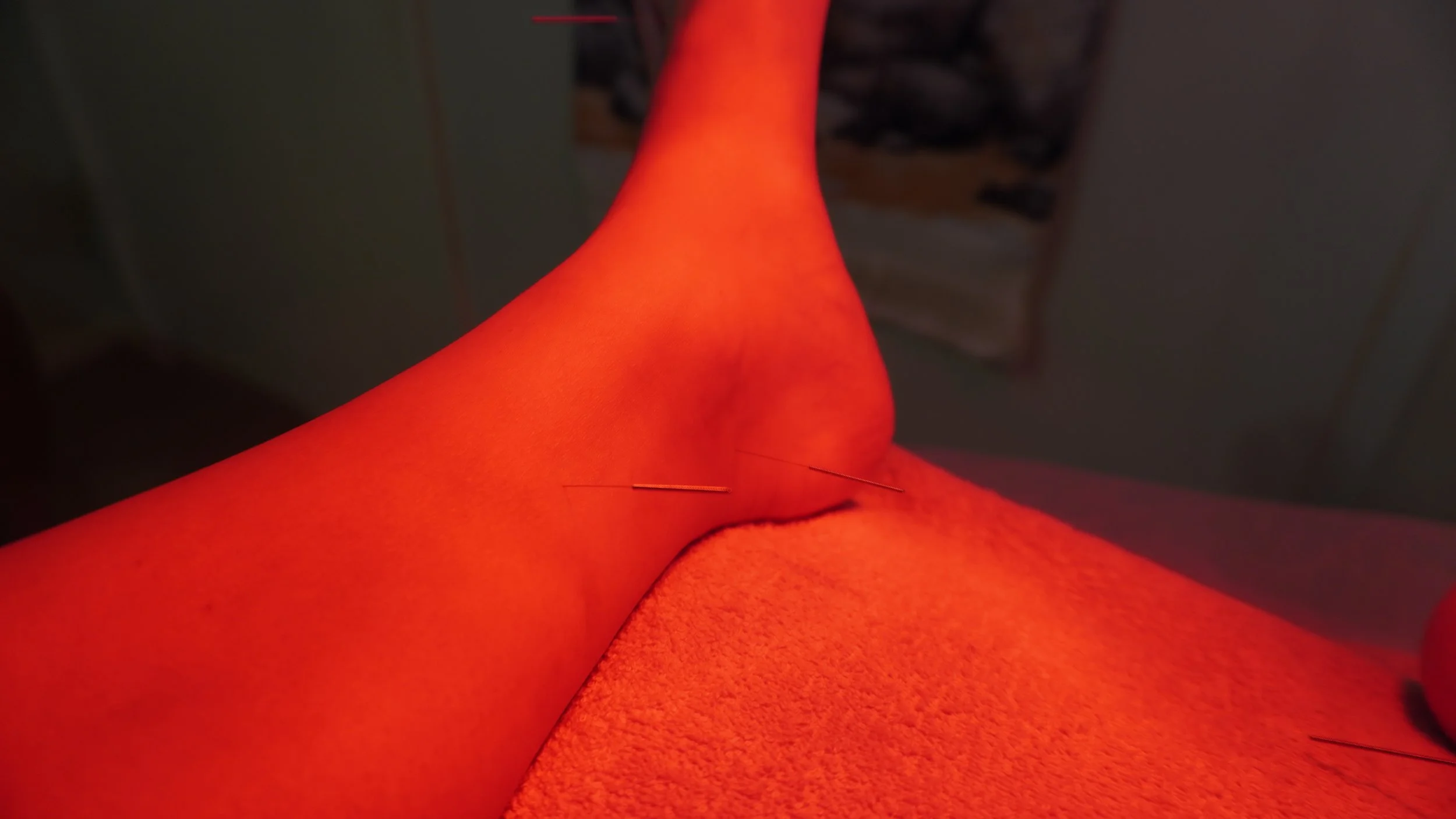 Close-up of a person's ankle with acupuncture needles inserted into the skin on an orange towel or cloth.