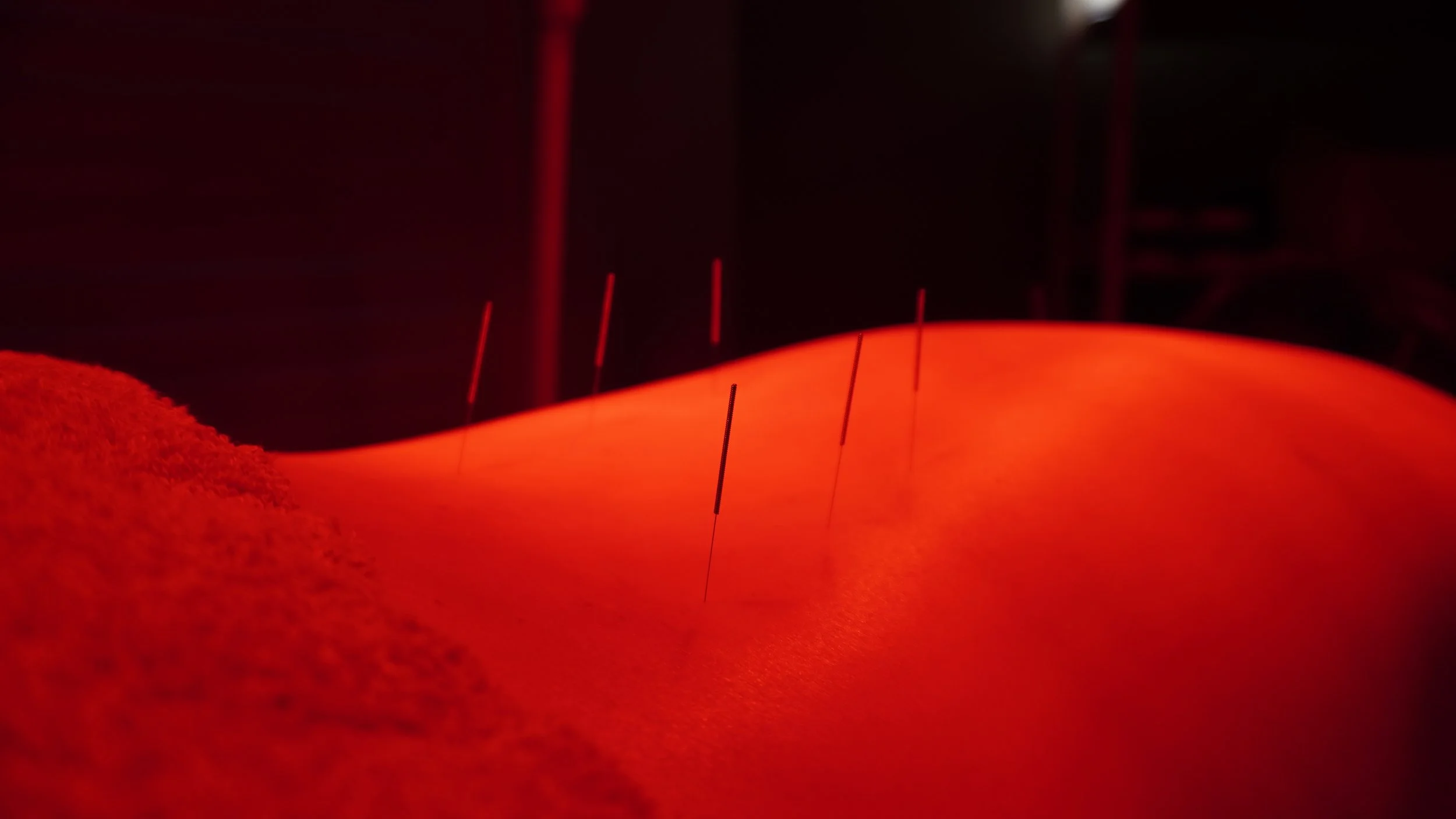Close-up of a person's back with acupuncture needles inserted, illuminated with red light.