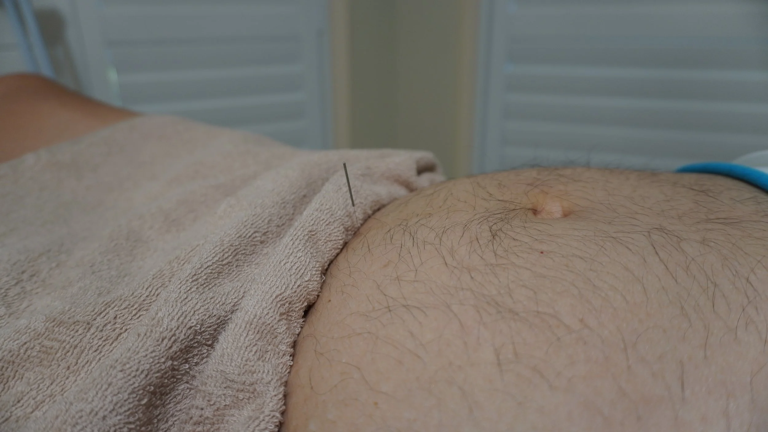 Close-up of a person's abdomen with an acupuncture needle inserted near the belly button.