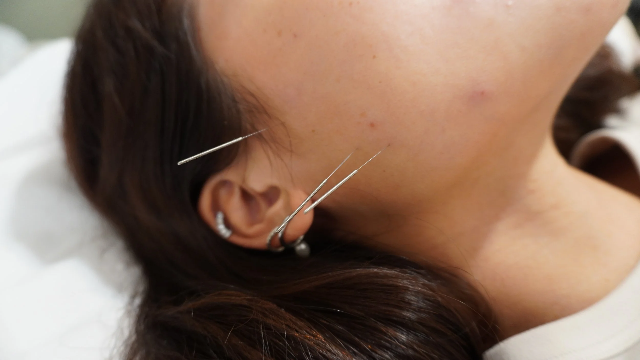 Close-up of a woman's face and ear with acupuncture needles inserted in her ear and near her temple, lying down on a white surface.