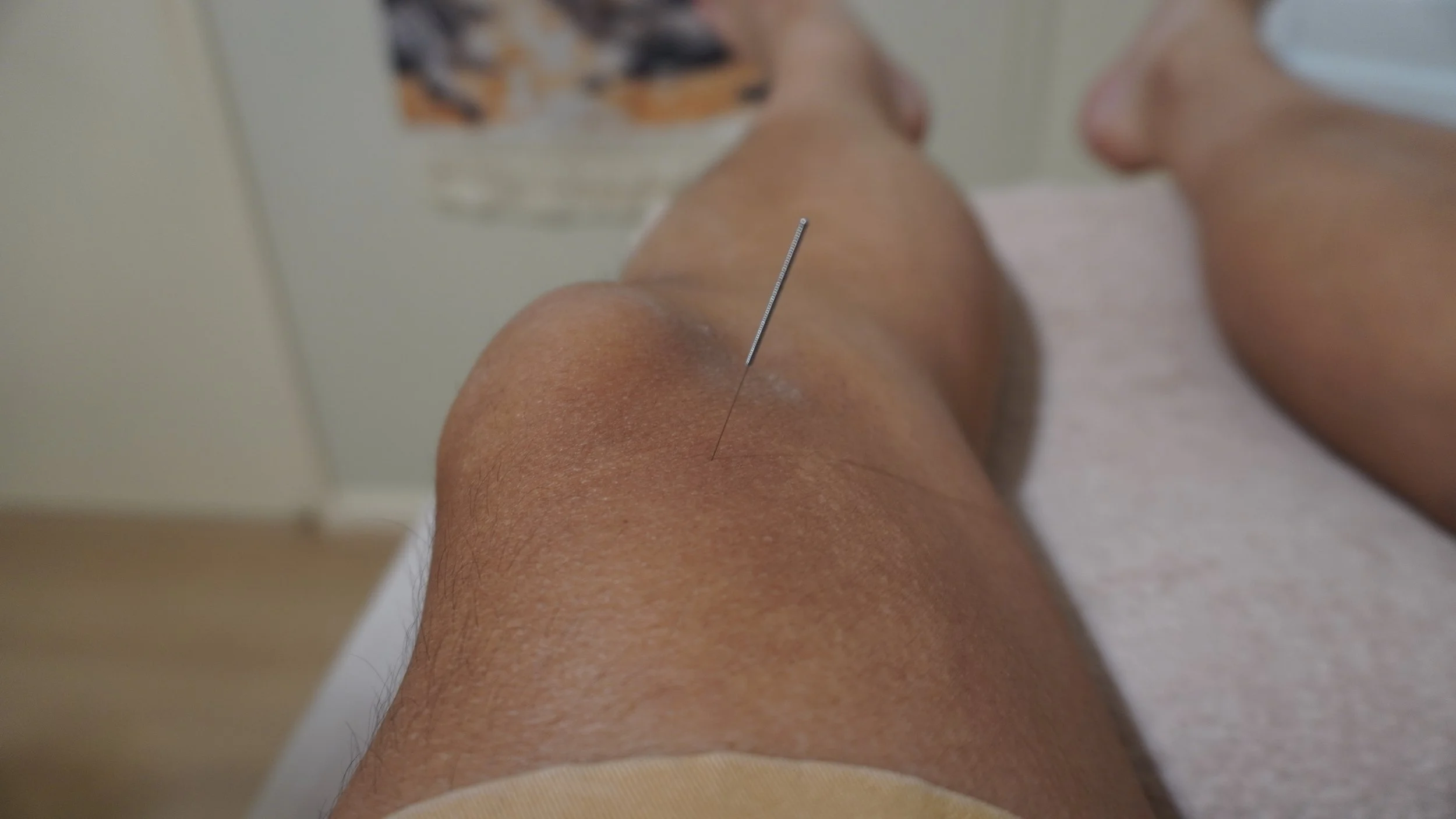 Close-up of a person's shaved leg with a sewing needle embedded in the skin.