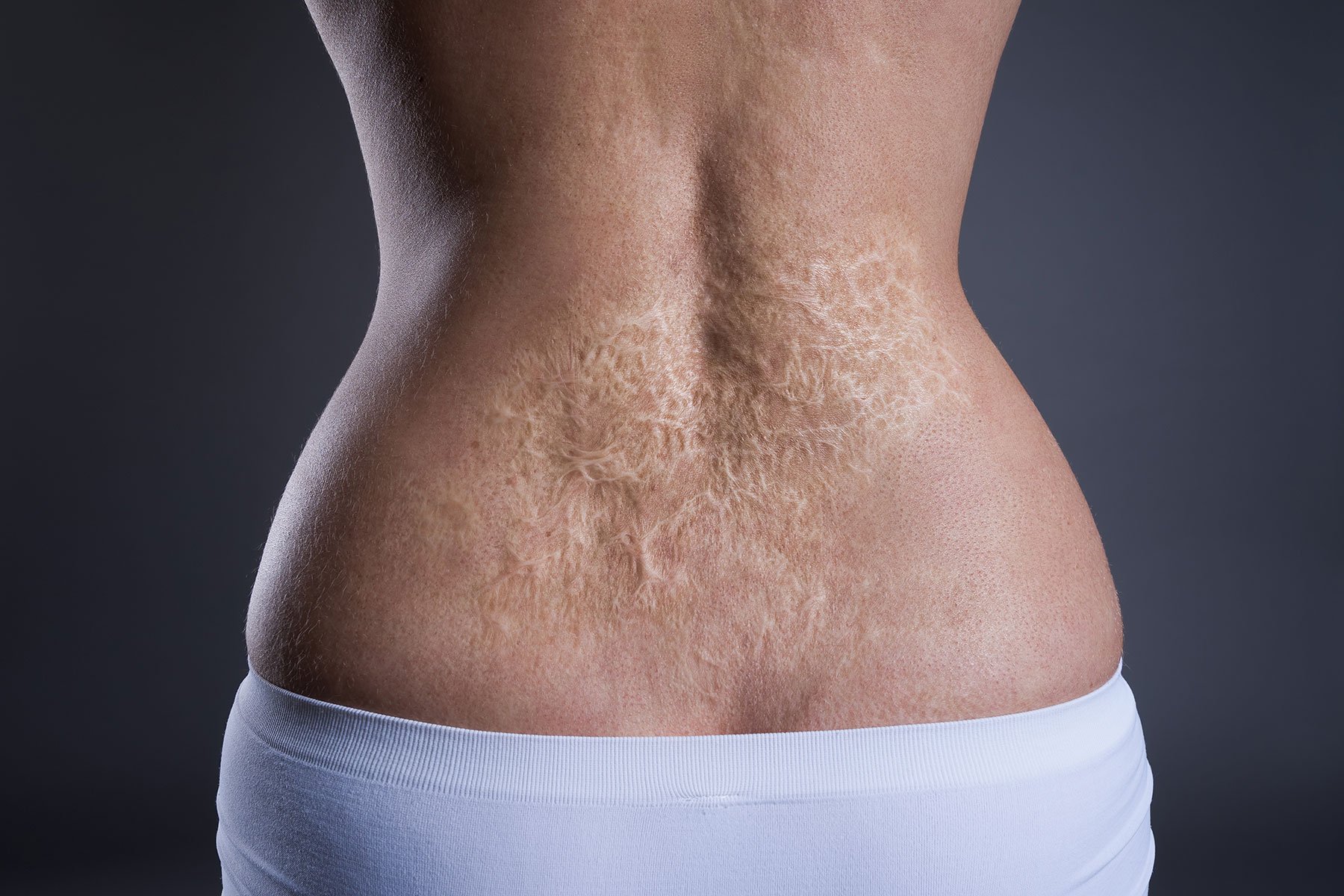 Lower back stretch marks and scarring.jpg