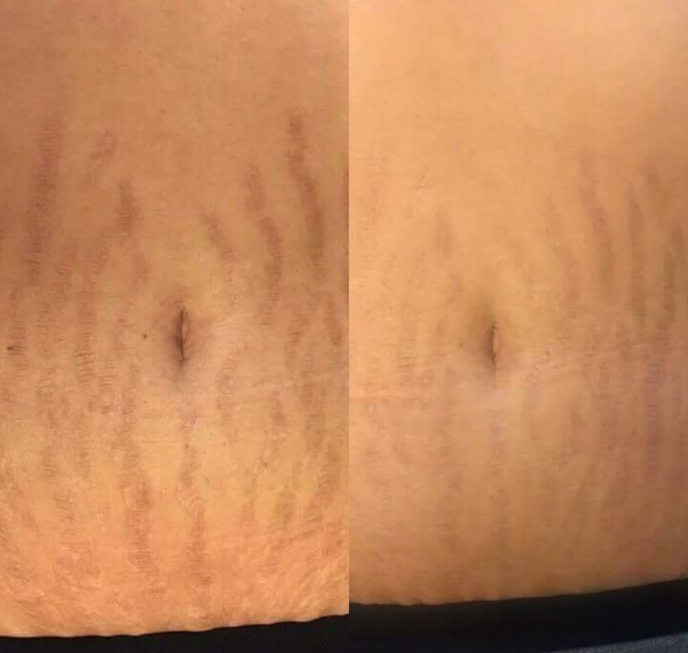 Stretch Marks pre and post microneedling treatment
