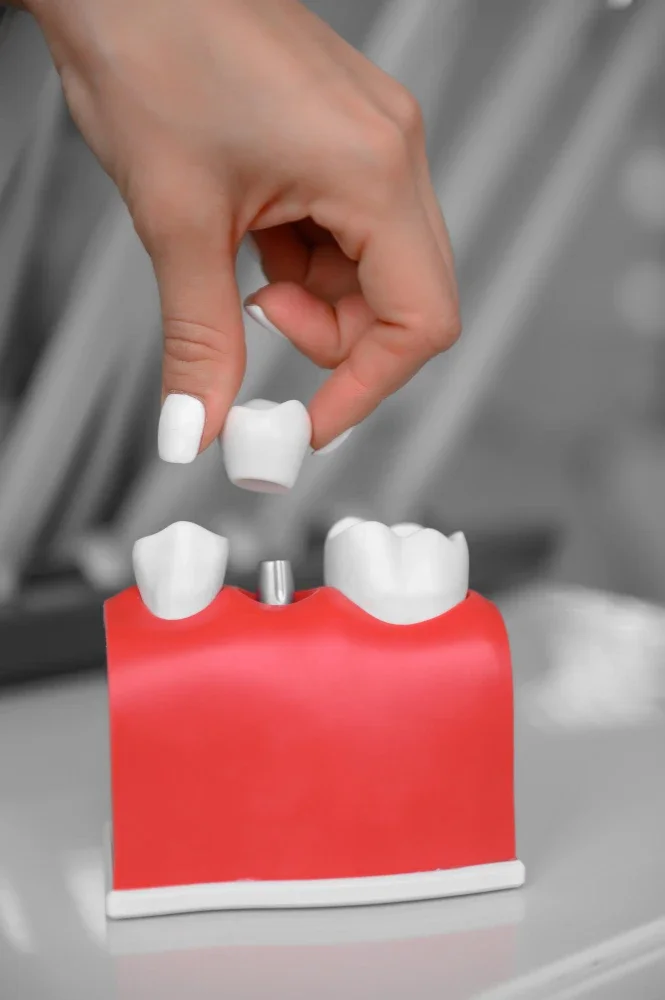 Dental Crowns