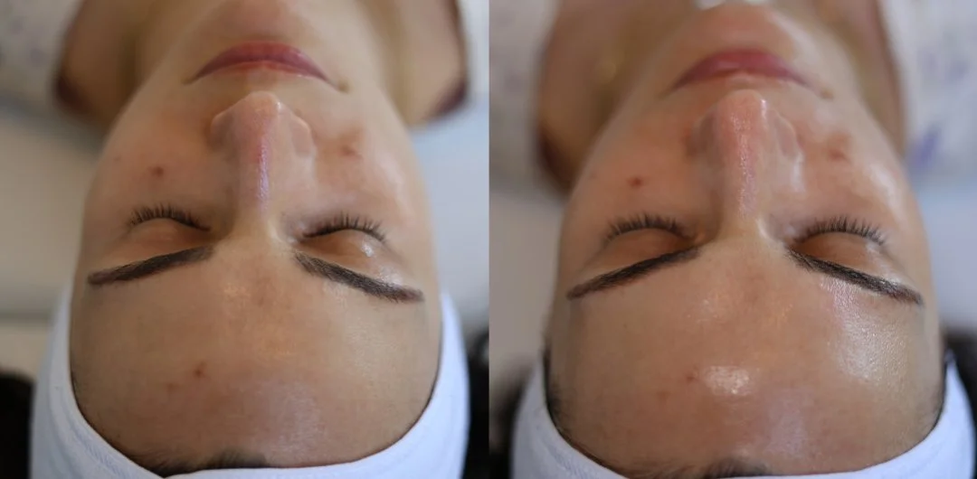 radiance-dermafacial-05.jpeg