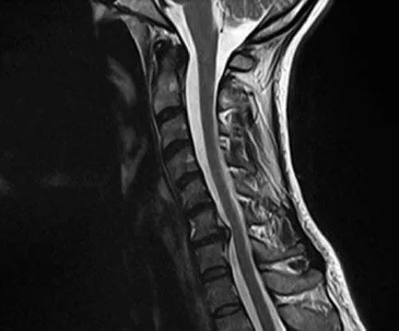 Hernia de disco cervical