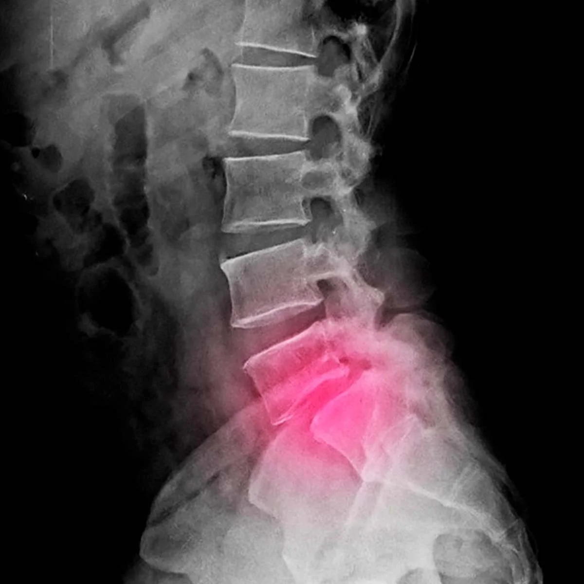 Espondilolistesis