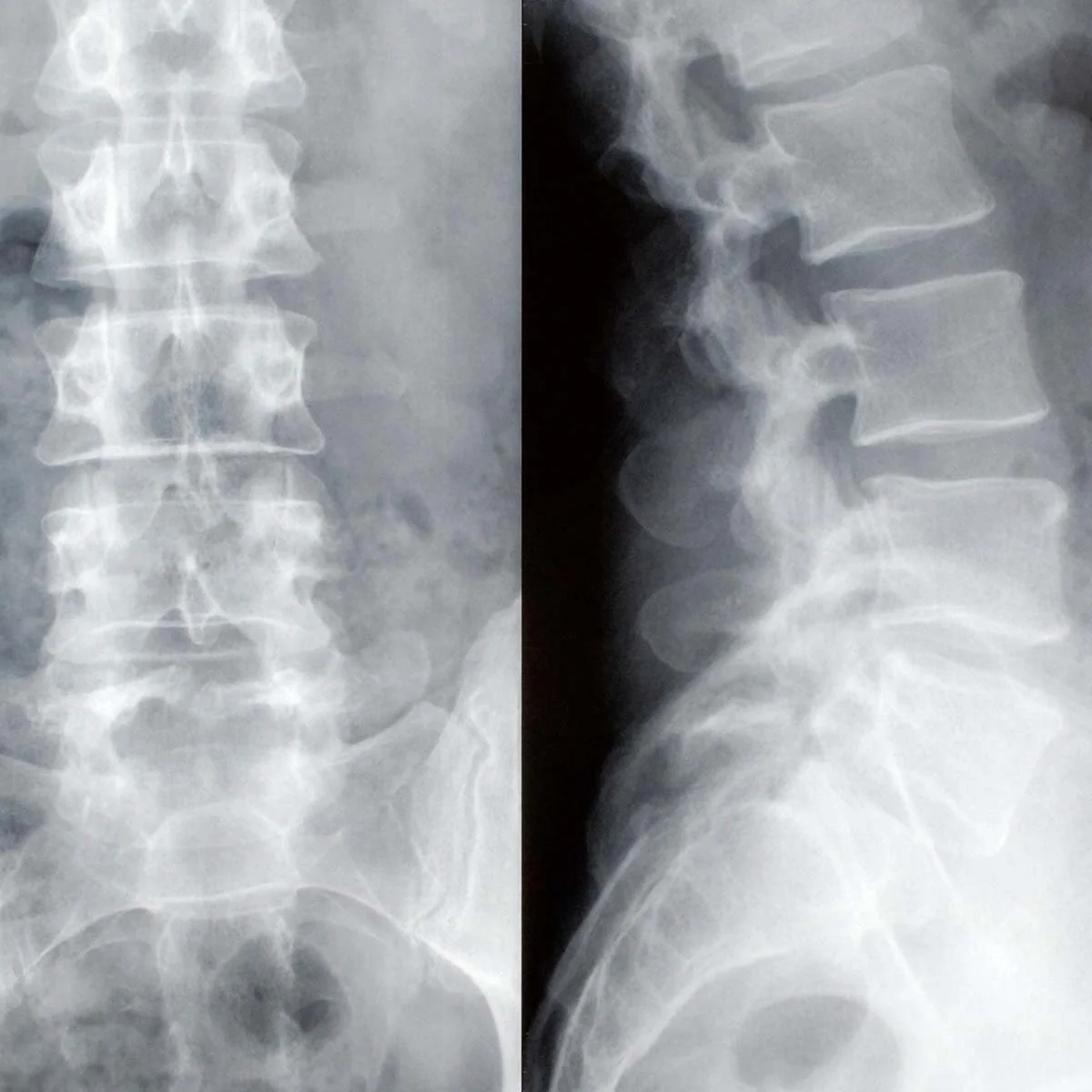 Osteoporosis de columna